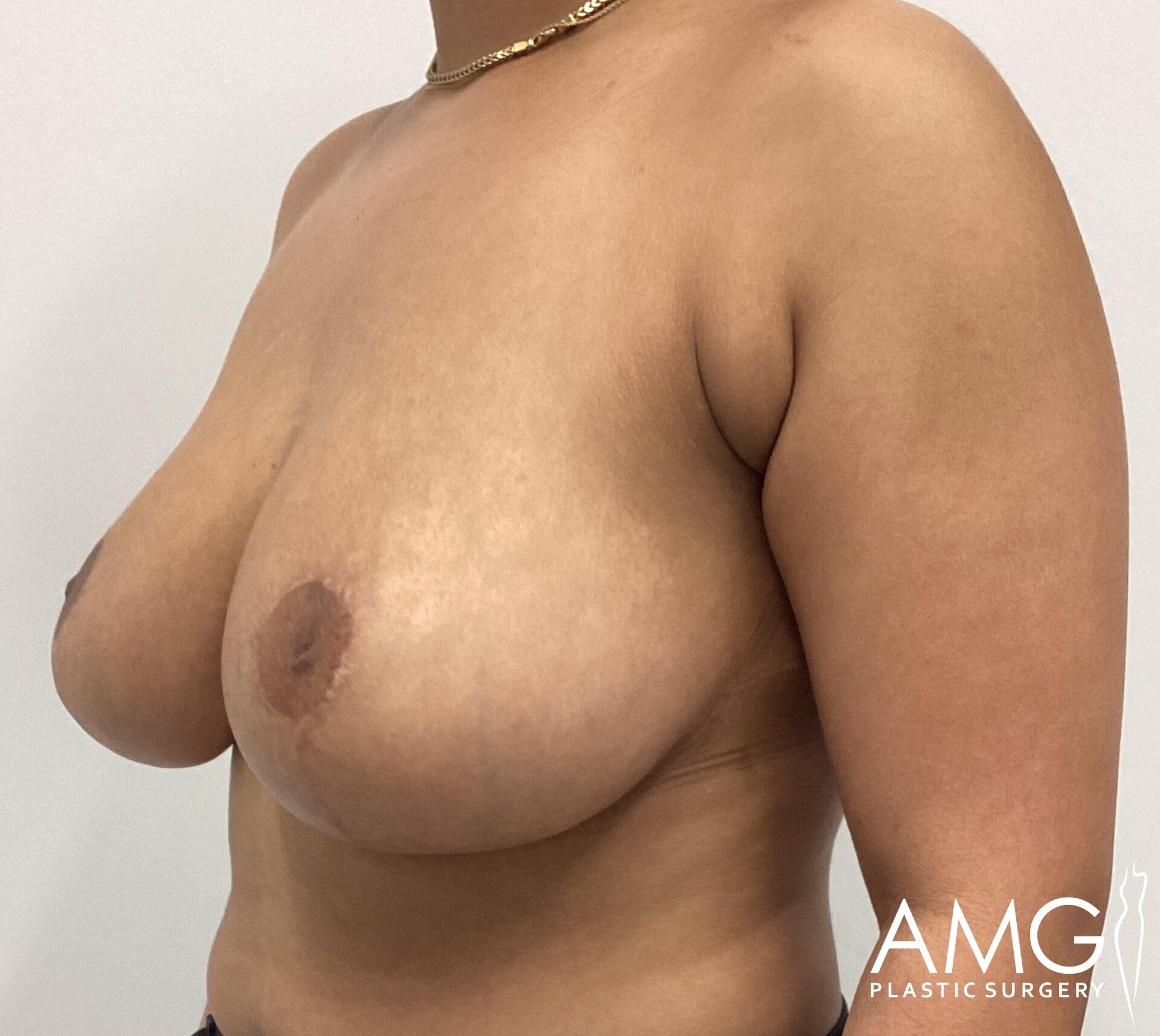 Side view of a bare-chested person with visible breast tissue and a gold necklace, against a plain background. Logo of AMG Plastic Surgery is visible at the bottom right.