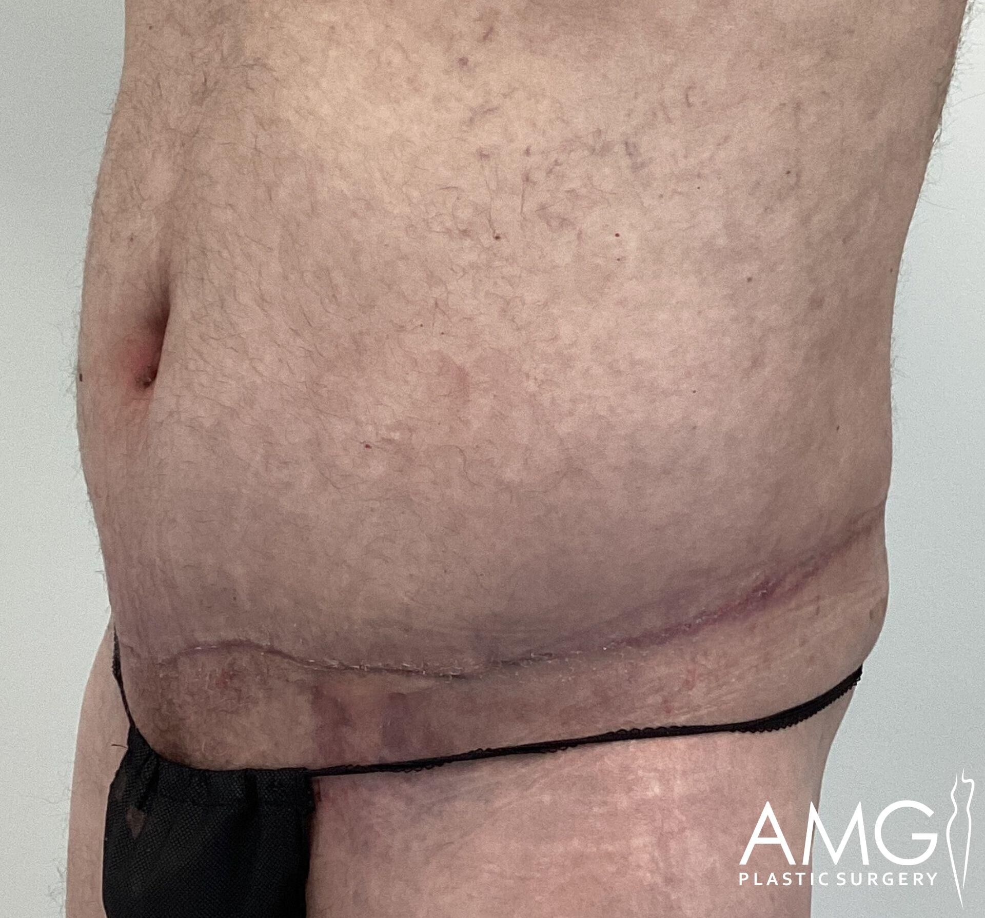 Side view of a person's abdomen with a visible surgical scar near the lower stomach area.
