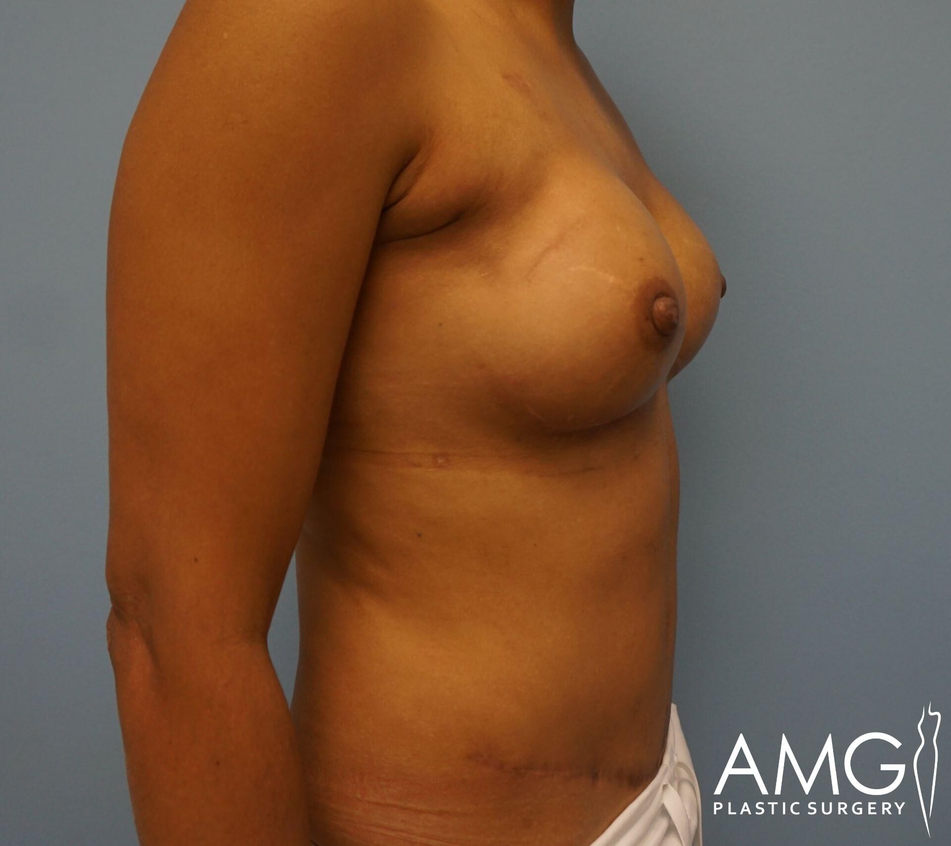 Person with visible breast scar in profile view against a blue background, with AMG Plastic Surgery logo in the corner.