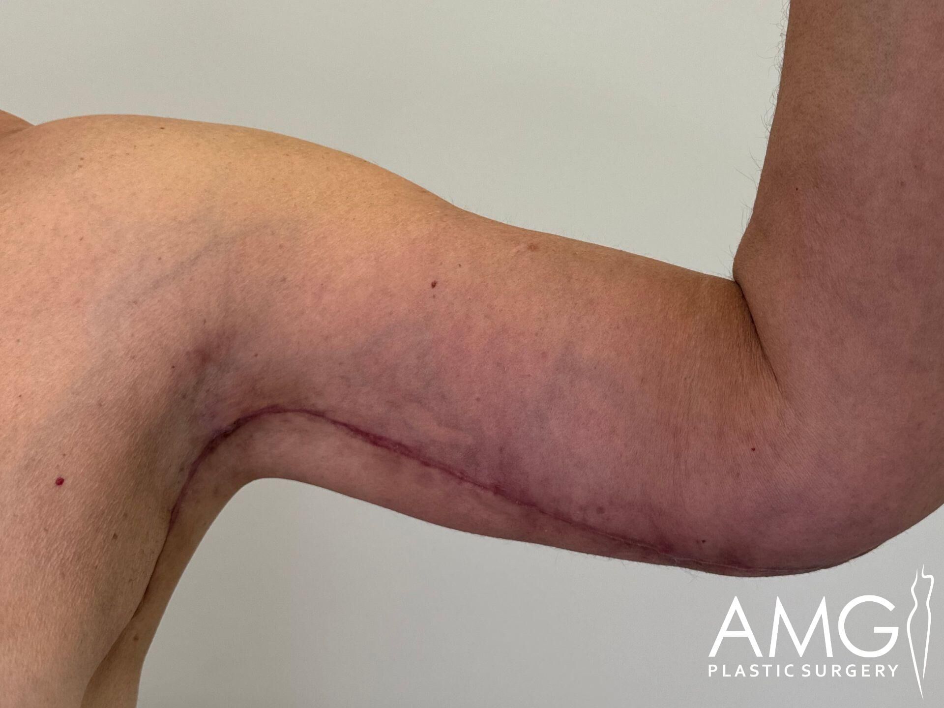 Close-up of a person's arm showing a long surgical scar running from the elbow to the armpit. Skin appears slightly discolored around the area.