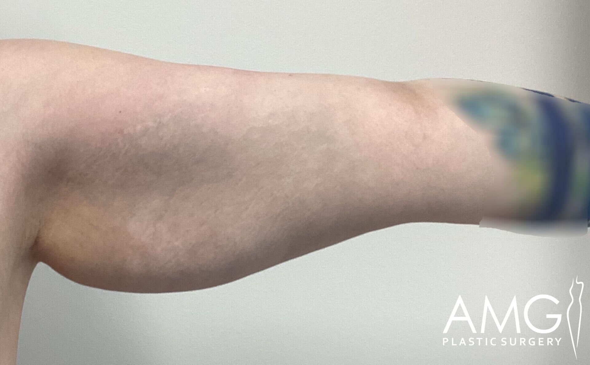 Side view of an arm with sagging skin, showing a blurred tattoo. The AMG Plastic Surgery logo is visible in the corner.