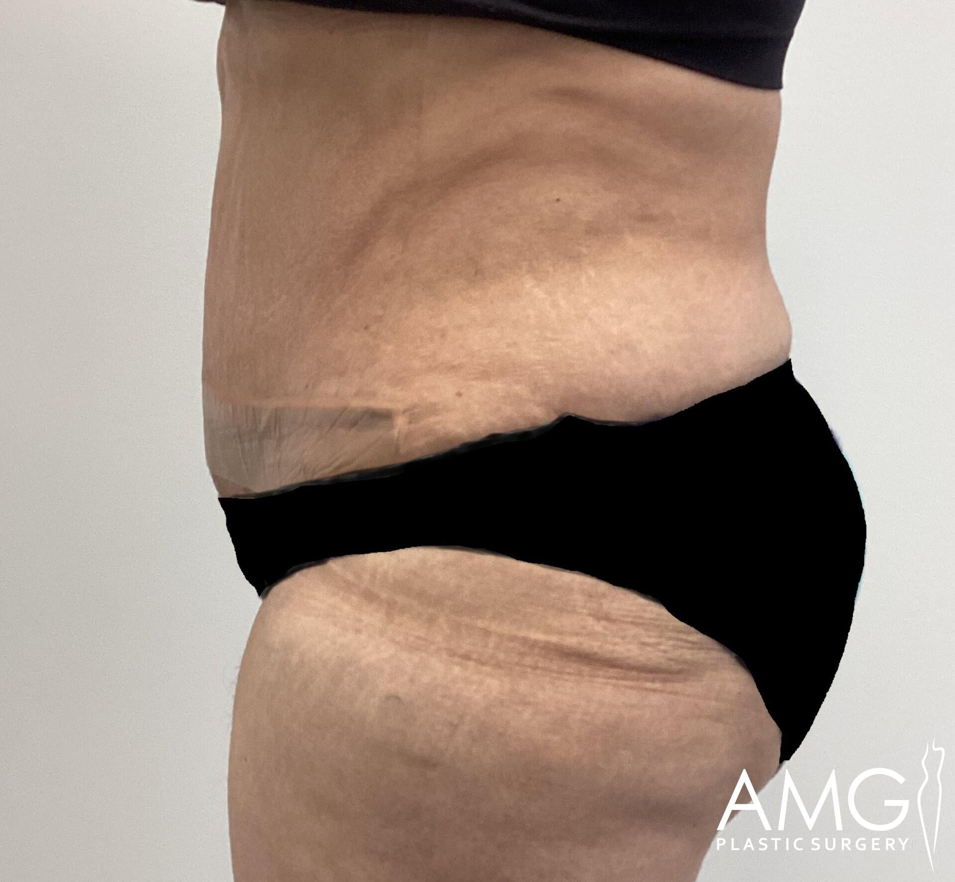 Side view of a person’s abdomen and lower torso, showing skin texture. The person is wearing black bottoms. Logo in the corner reads "AMG Plastic Surgery.