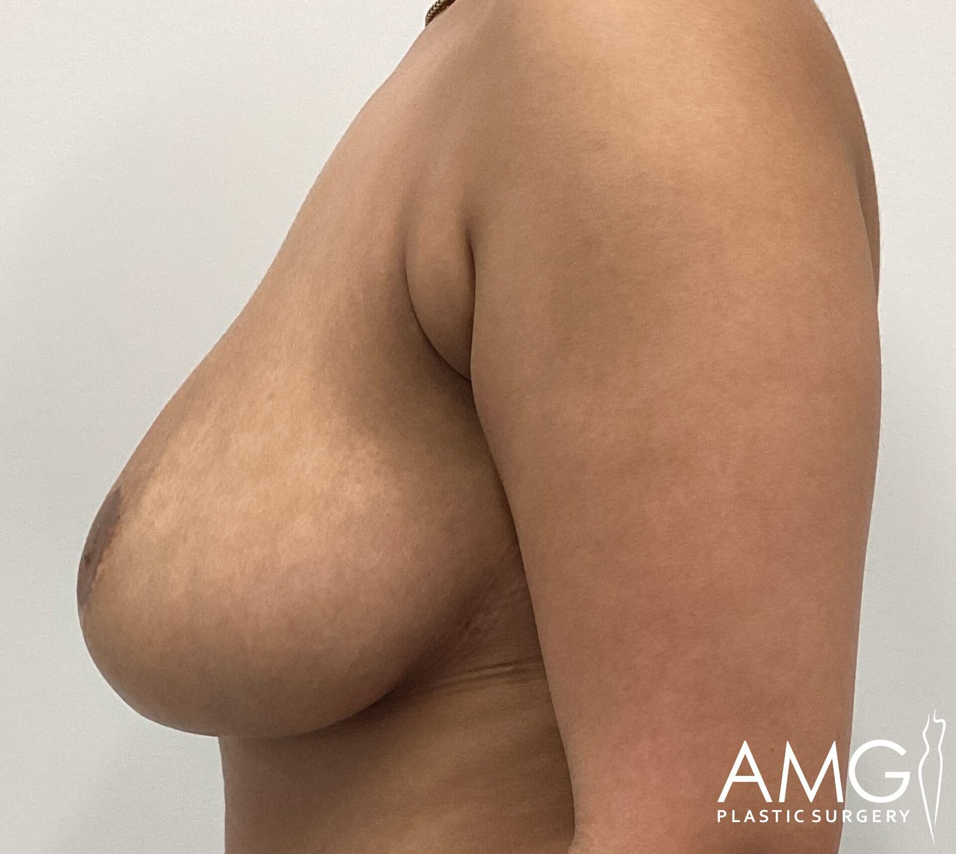 Profile view of a person’s bare torso, showing one breast, against a plain background.