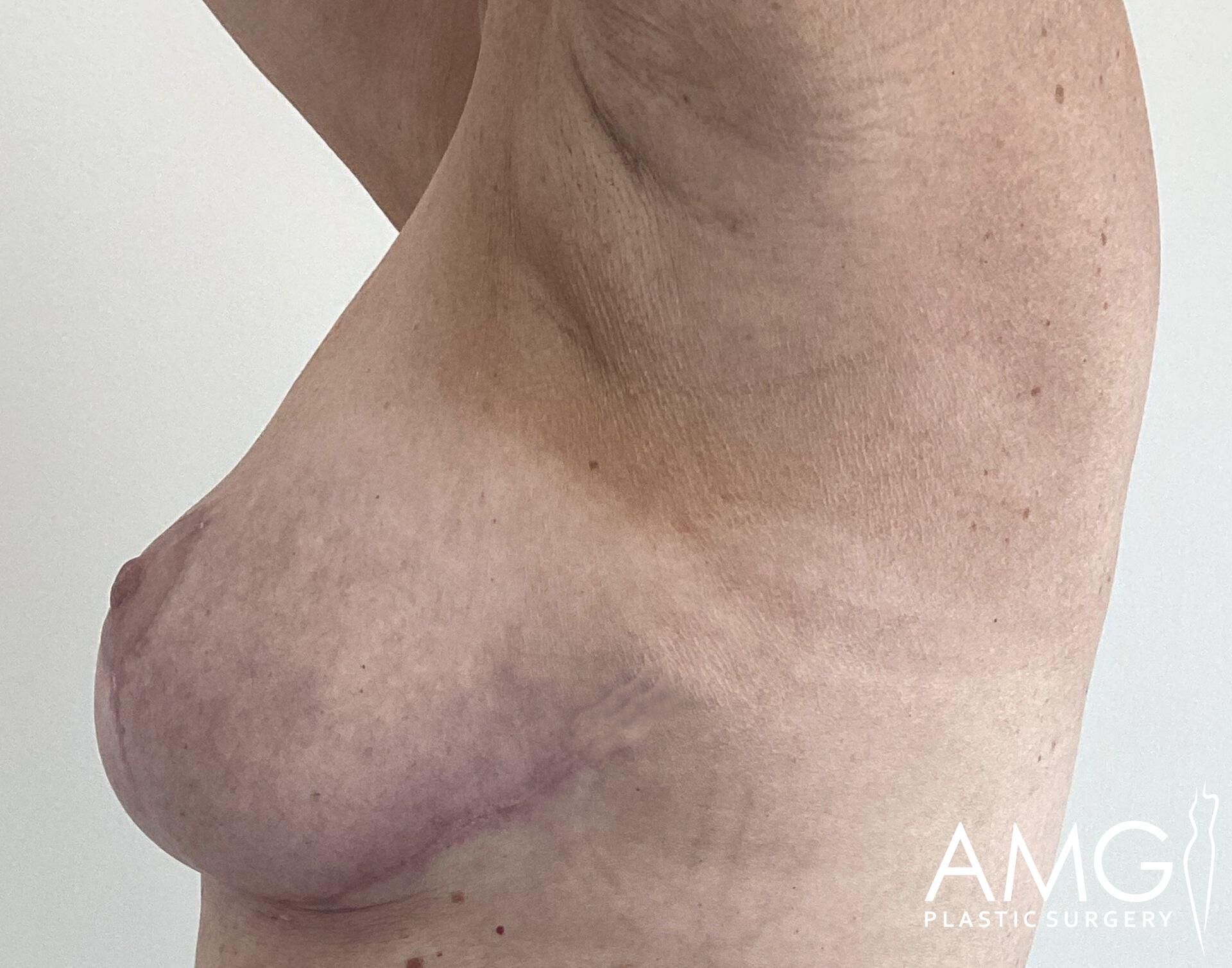 Side view of a person's bare chest showing post-surgical changes. There is visible sagging and skin texture, with a logo at the bottom right corner.