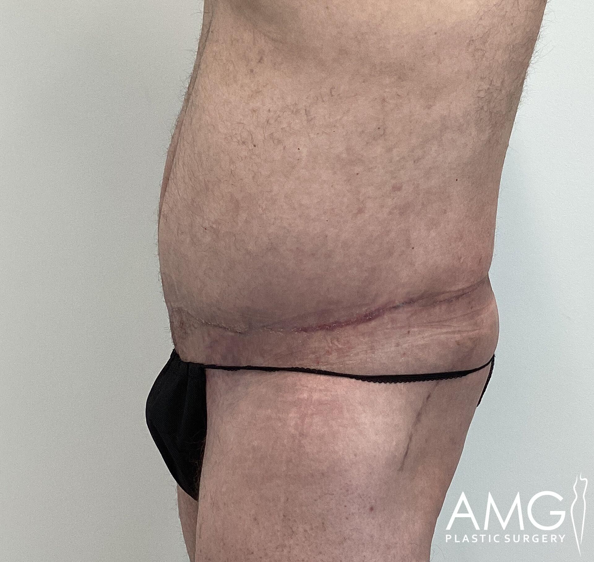 Side view of a person's midsection showing a healing surgical scar and sutures, wearing black undergarments.
