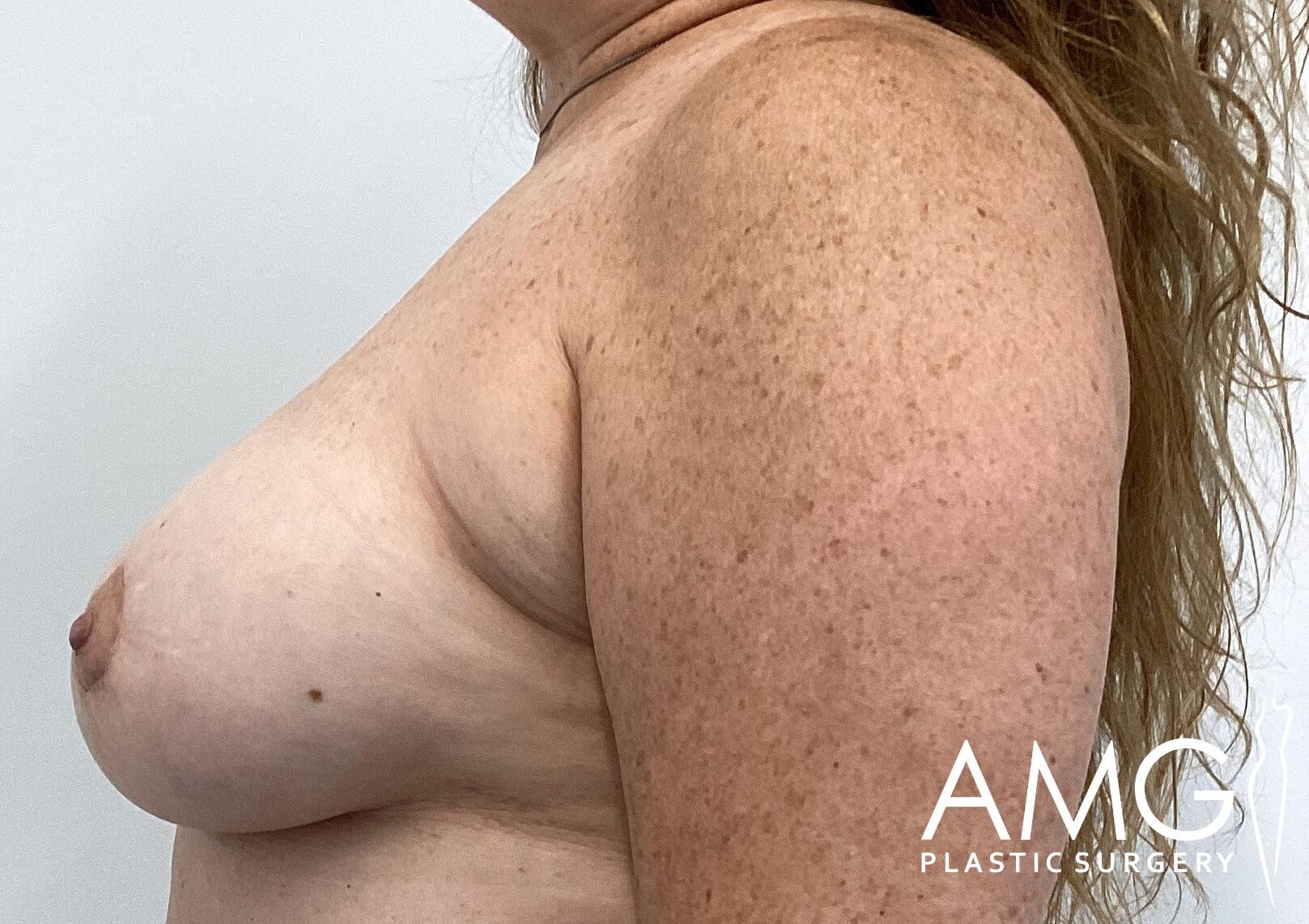 Side profile of a person's bare chest and shoulder against a plain background. Logo in the corner reads "AMG Plastic Surgery.