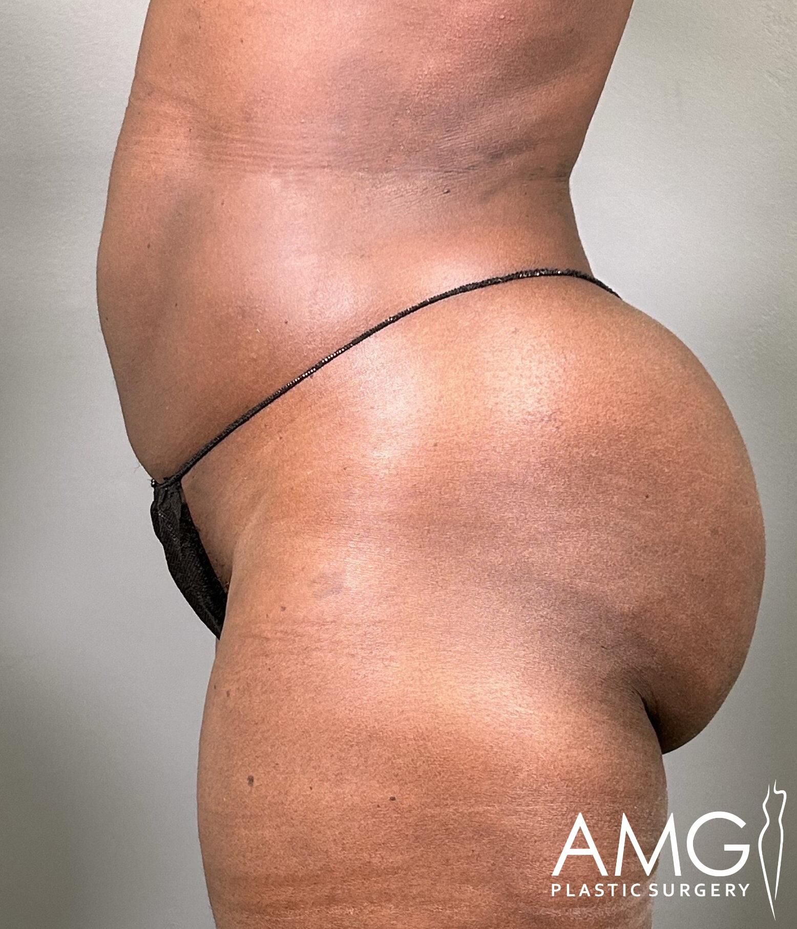 Person posing in profile view wearing a black thong. The image has a watermark saying "AMG Plastic Surgery" in the corner.