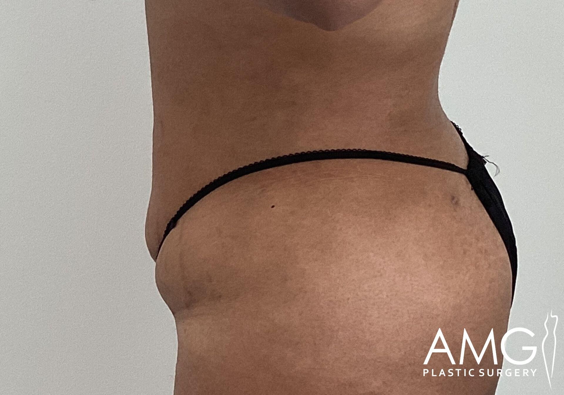 Side view of a person wearing a black bikini bottom, showing the midsection and part of the thigh. The image has a "AMG Plastic Surgery" logo in the corner.
