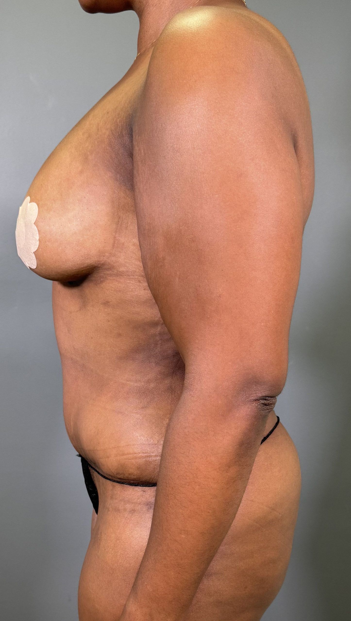Side profile of a person with visible adhesive cover on their breast, standing against a plain background. The image includes a logo for AMG Plastic Surgery.