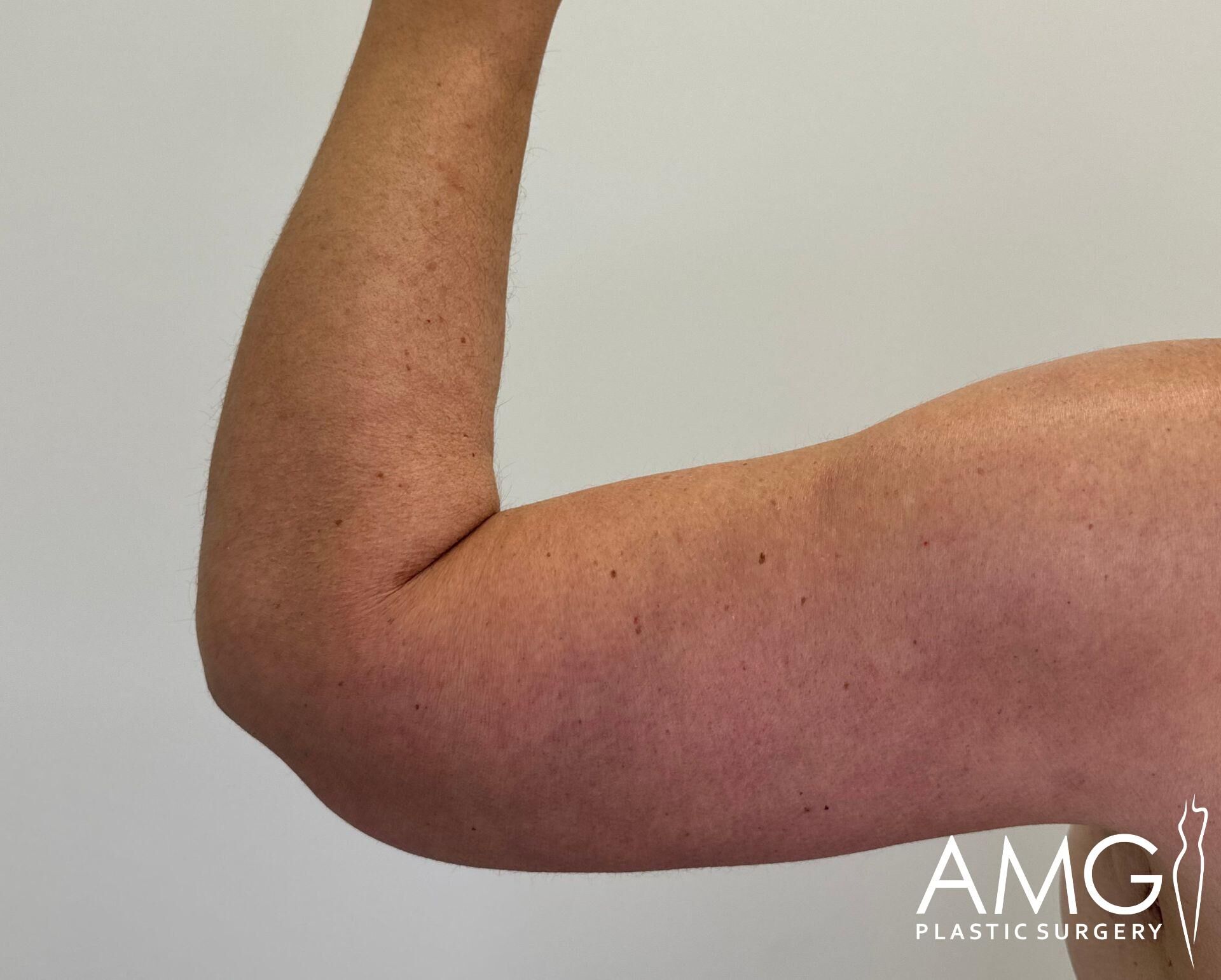 Close-up of a person's flexed arm against a plain background, showing muscle definition.