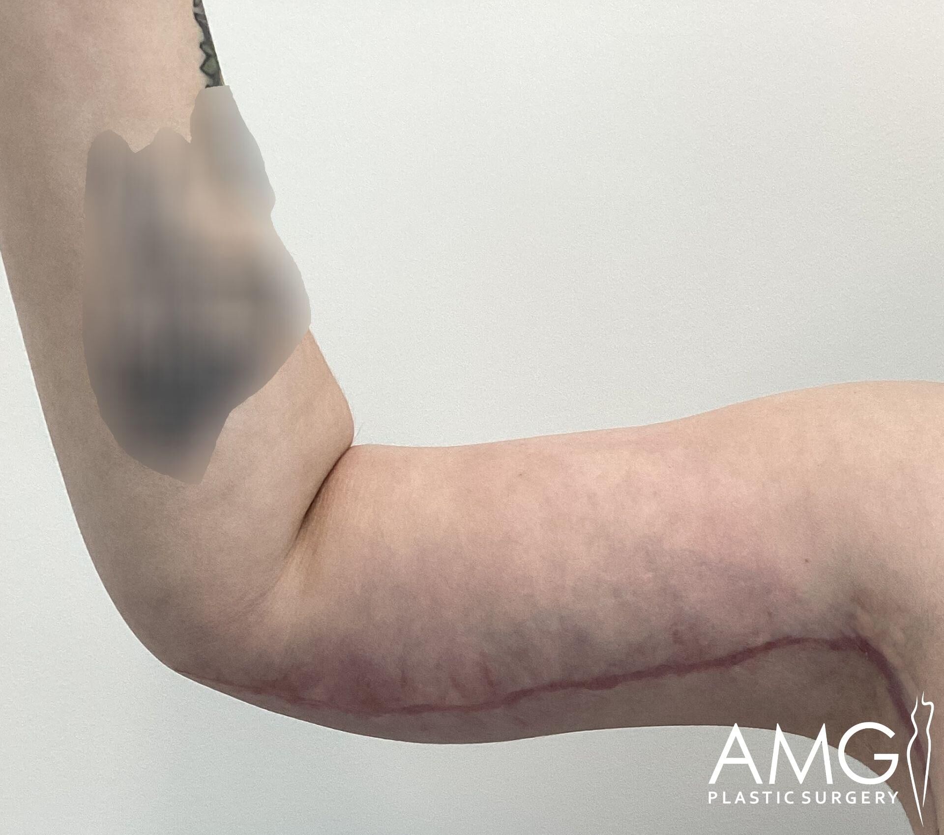 A close-up of a person's arm showing a healing surgical scar along the underside, with a blurred tattoo on the upper arm.