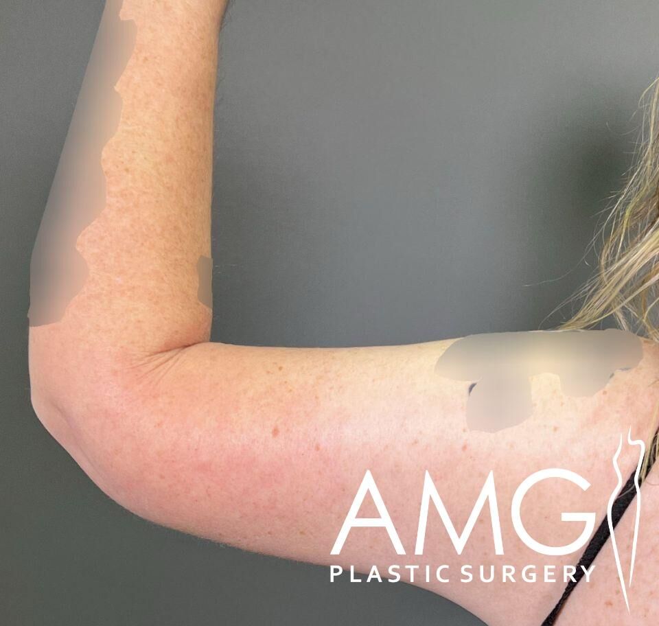 Person's flexed arm with blurred areas, displaying skin texture, against a gray background. Logo for AMG Plastic Surgery is present in the corner.