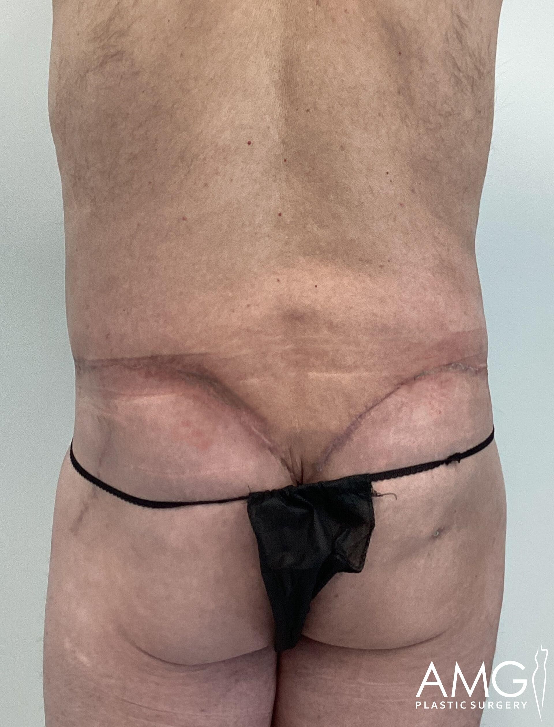 Person in a thong showing a back view with surgical scars and markings near the waist.