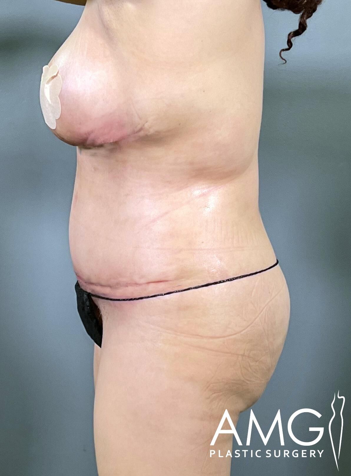 Side view of a person’s torso with visible surgical scars, a bandage on the upper area, and underwear. Logo at the bottom right reads "AMG Plastic Surgery.
