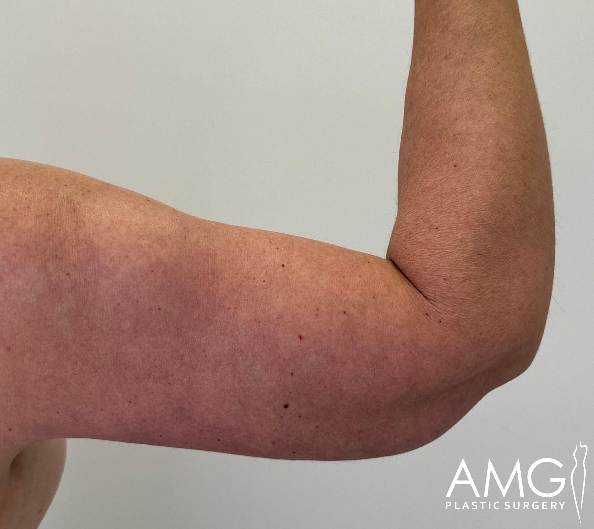 A close-up of a person's flexed arm showing skin tone, muscle definition, and hair, against a plain background.