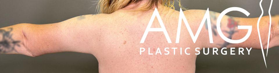 Person with arms extended, showing tattoos on both arms, with AMG Plastic Surgery text overlay.