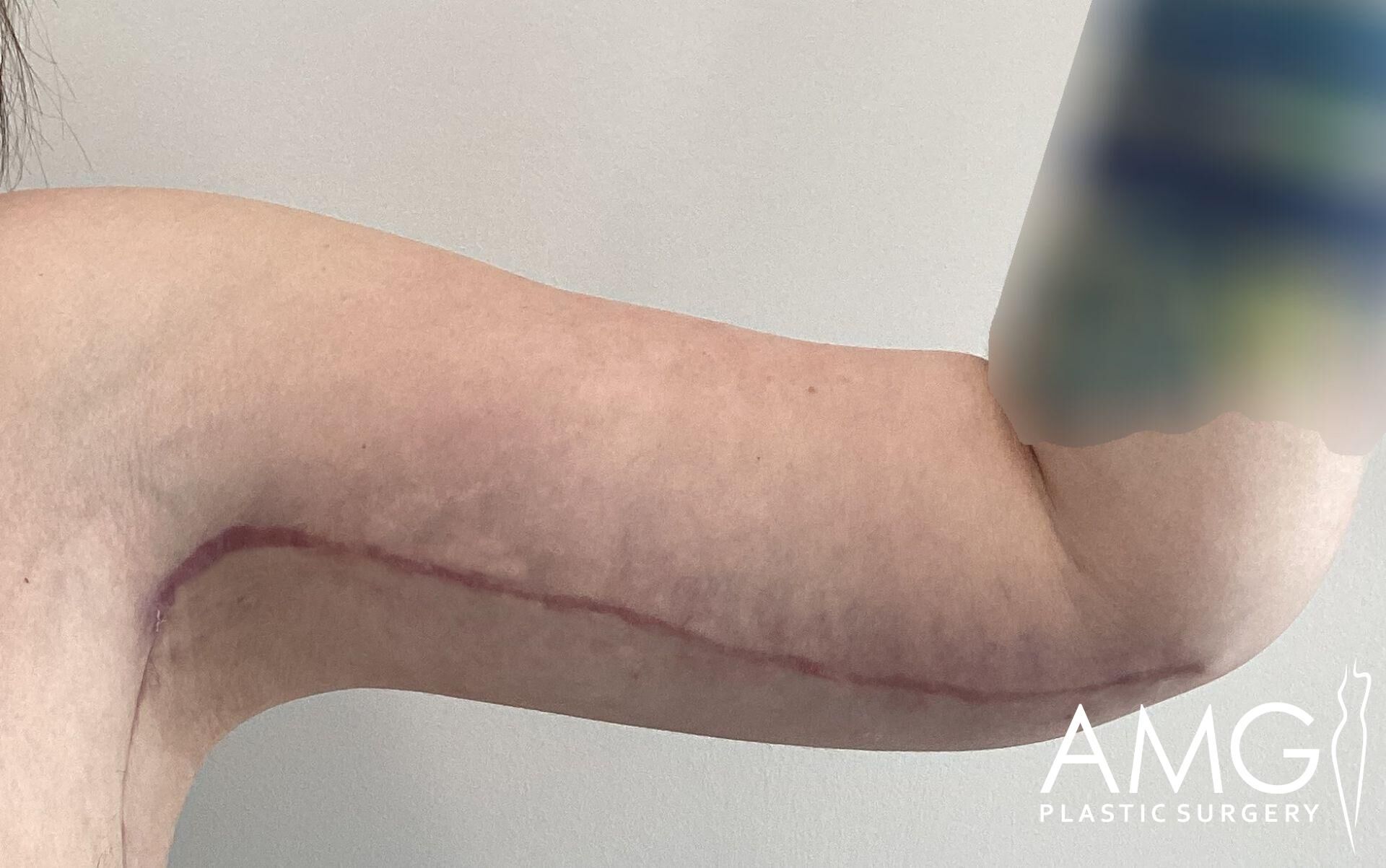 A close-up of an arm showing a surgical scar running from the elbow to the underarm.