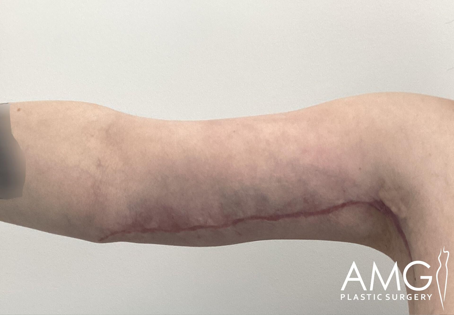 Close-up of a person's arm showing a surgical scar running from the elbow to the armpit. The image includes the logo "AMG Plastic Surgery" in the bottom right corner.