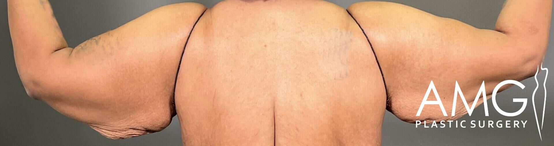 A person from the back with arms raised, showing excess skin and tissue on the upper arms. The logo 