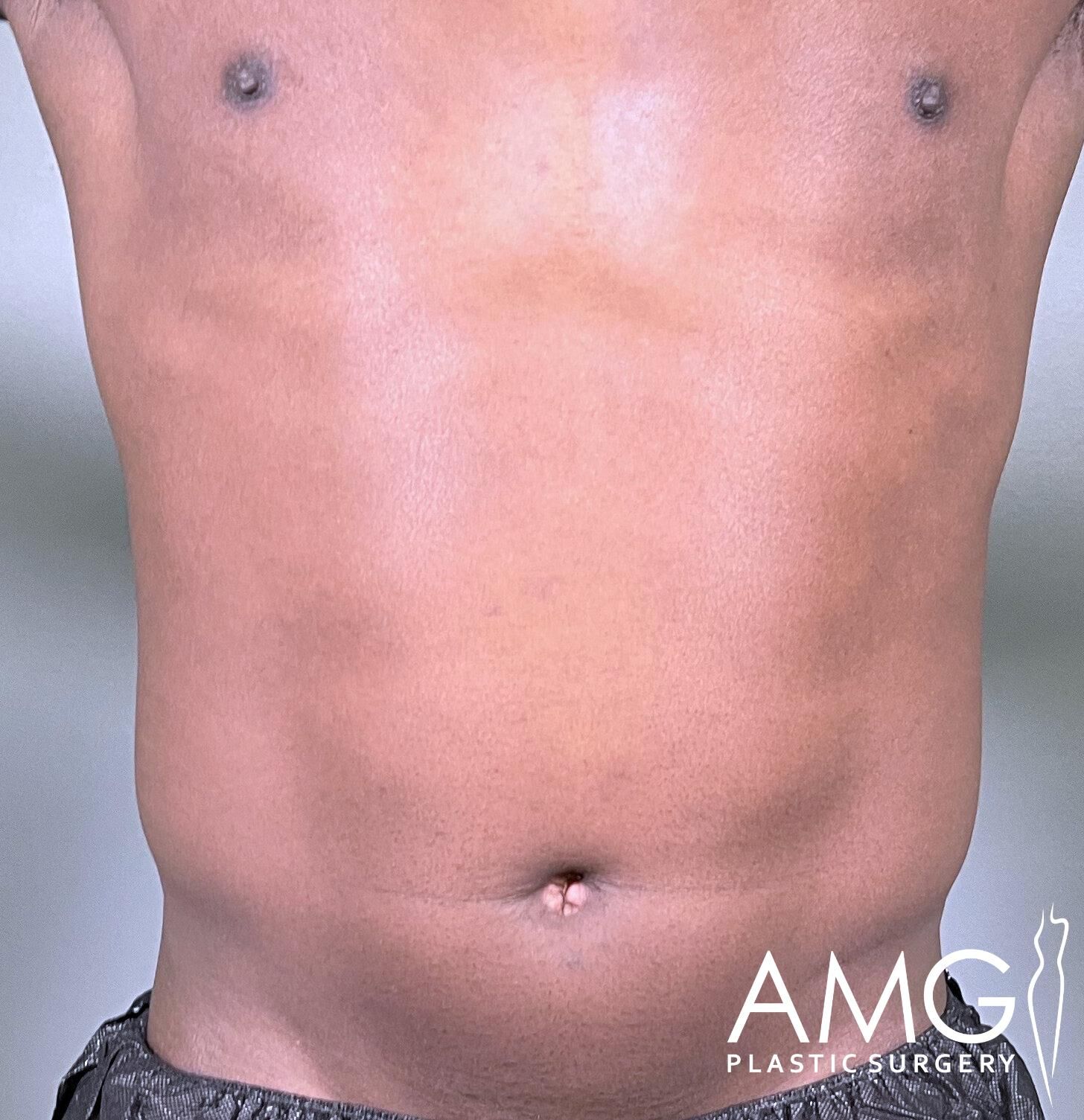 Close-up of a person's bare torso showing the abdomen area with a logo visible in the bottom right corner.