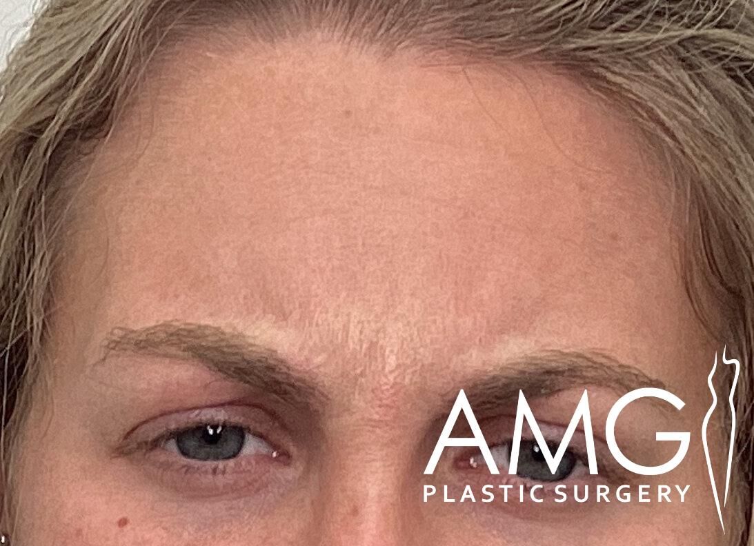 Close-up of a person's forehead and eyes, with the logo "AMG Plastic Surgery" in the lower right corner.