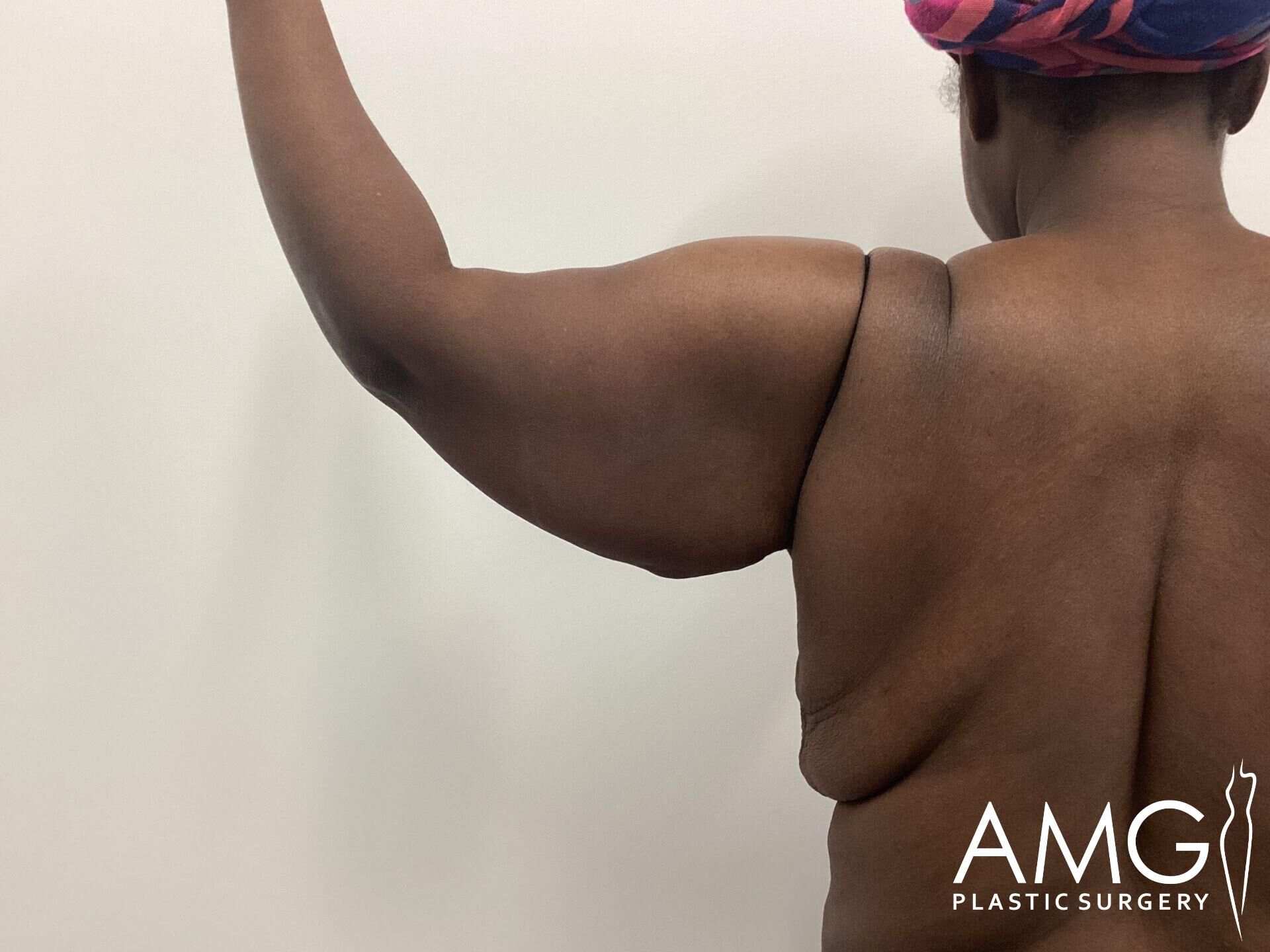 Person showing the back of their right arm with excess skin, wearing a multicolored headscarf, against a plain background. Logo for AMG Plastic Surgery is visible in the bottom right corner.
