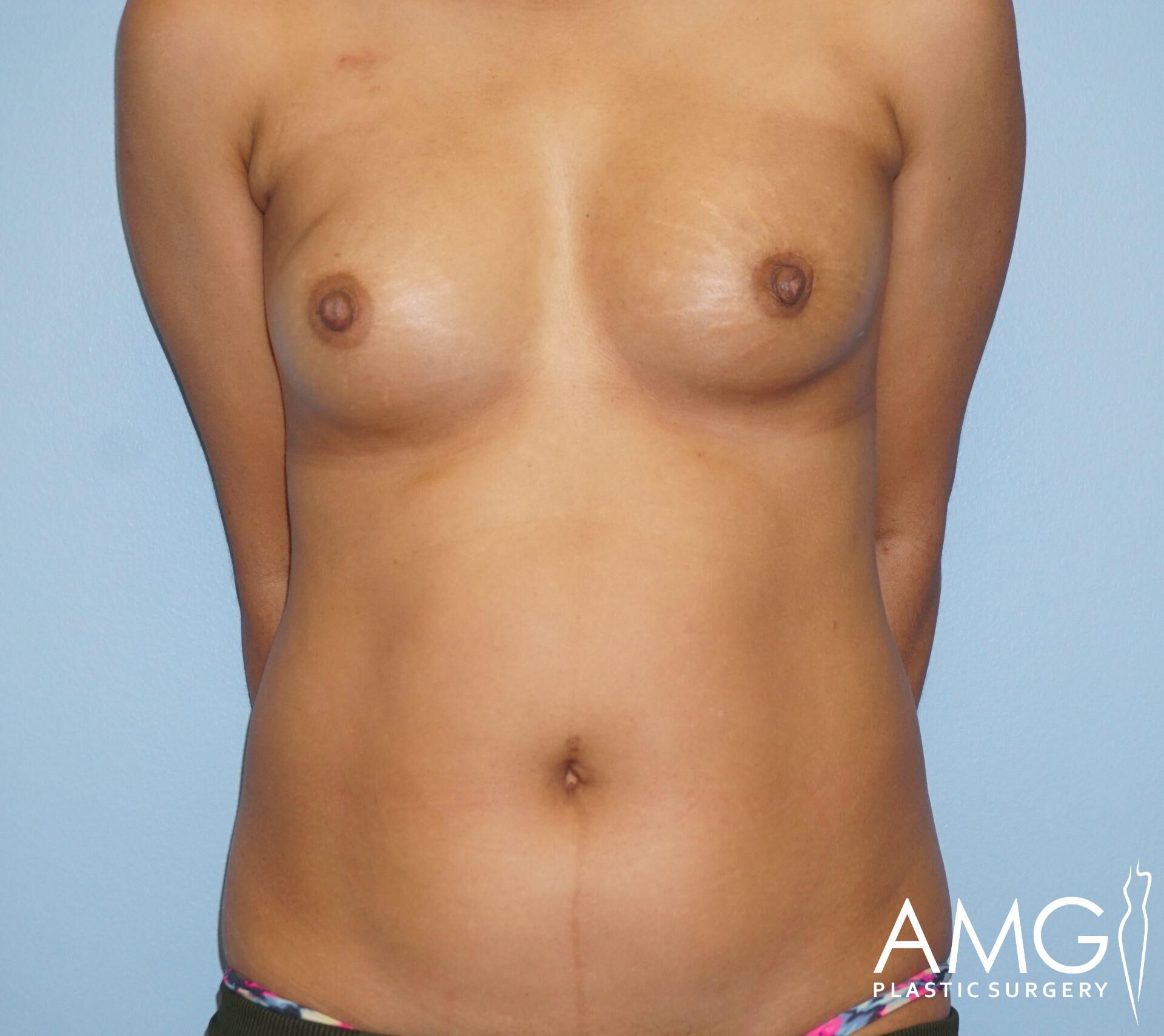 A person standing with a visible torso against a blue background. Logo in the corner reads "AMG Plastic Surgery.