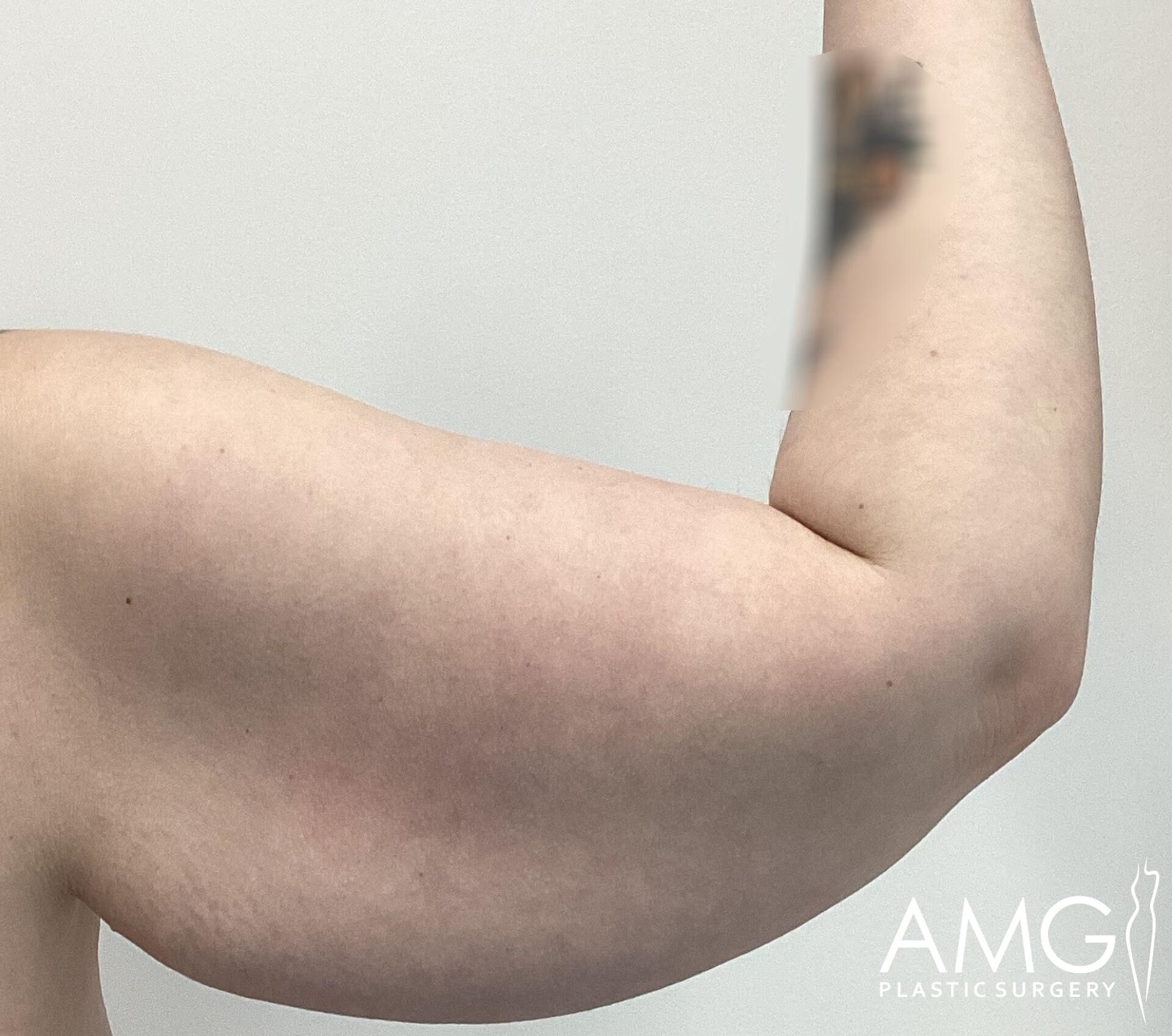 A close-up of a flexed arm with blurred tattoo, showing loose skin. "AMG Plastic Surgery" logo is visible in the corner.