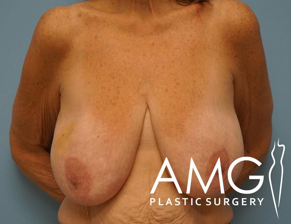 A woman's bare chest is shown against a blue background. The image has a watermark for AMG Plastic Surgery.