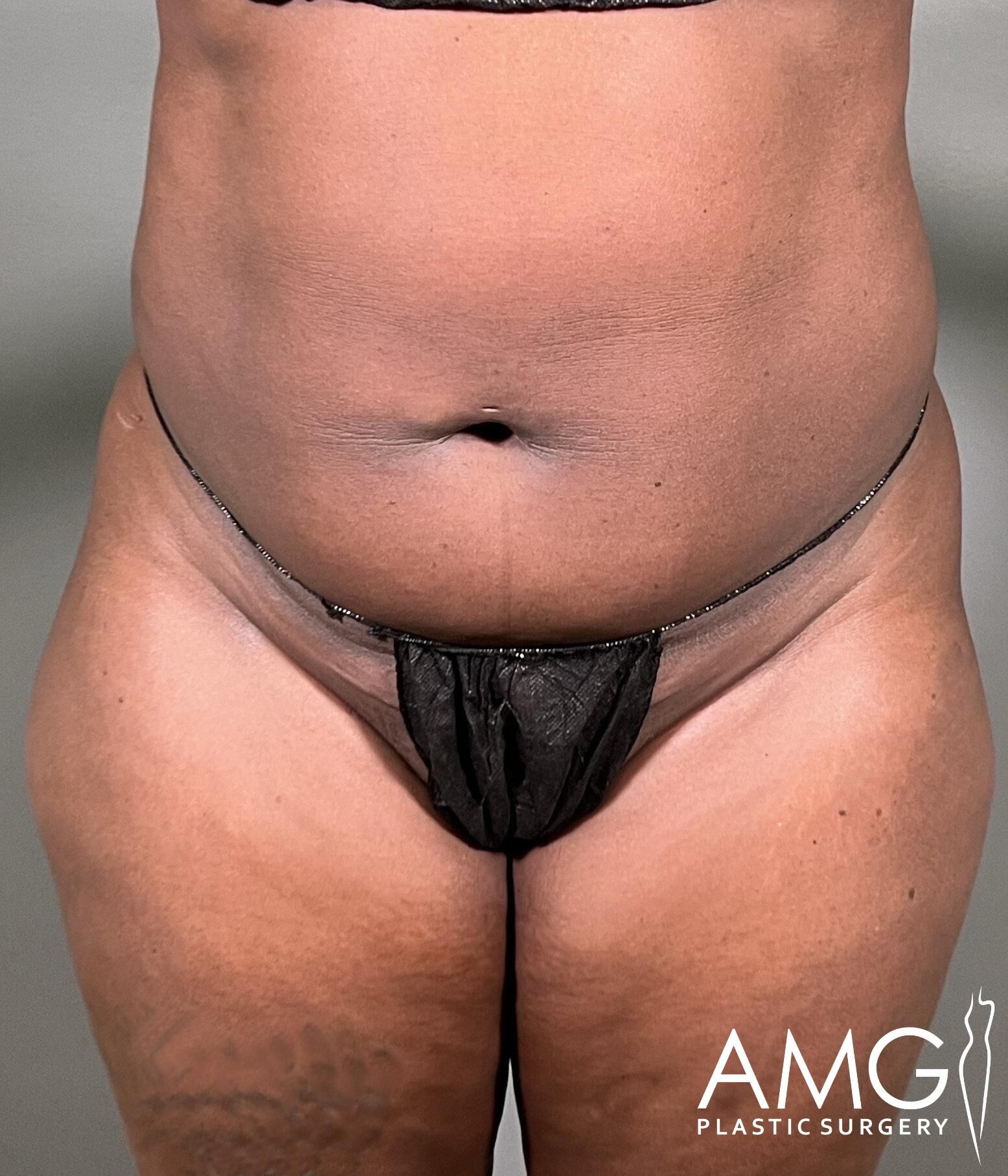 A person's abdomen with visible stretch marks, wearing black underwear. The image has a logo for AMG Plastic Surgery in the corner.