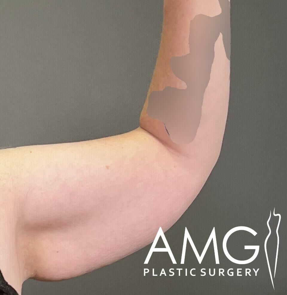 A person's bent arm with a shaded area near the tricep. The text "AMG Plastic Surgery" is at the bottom right corner.