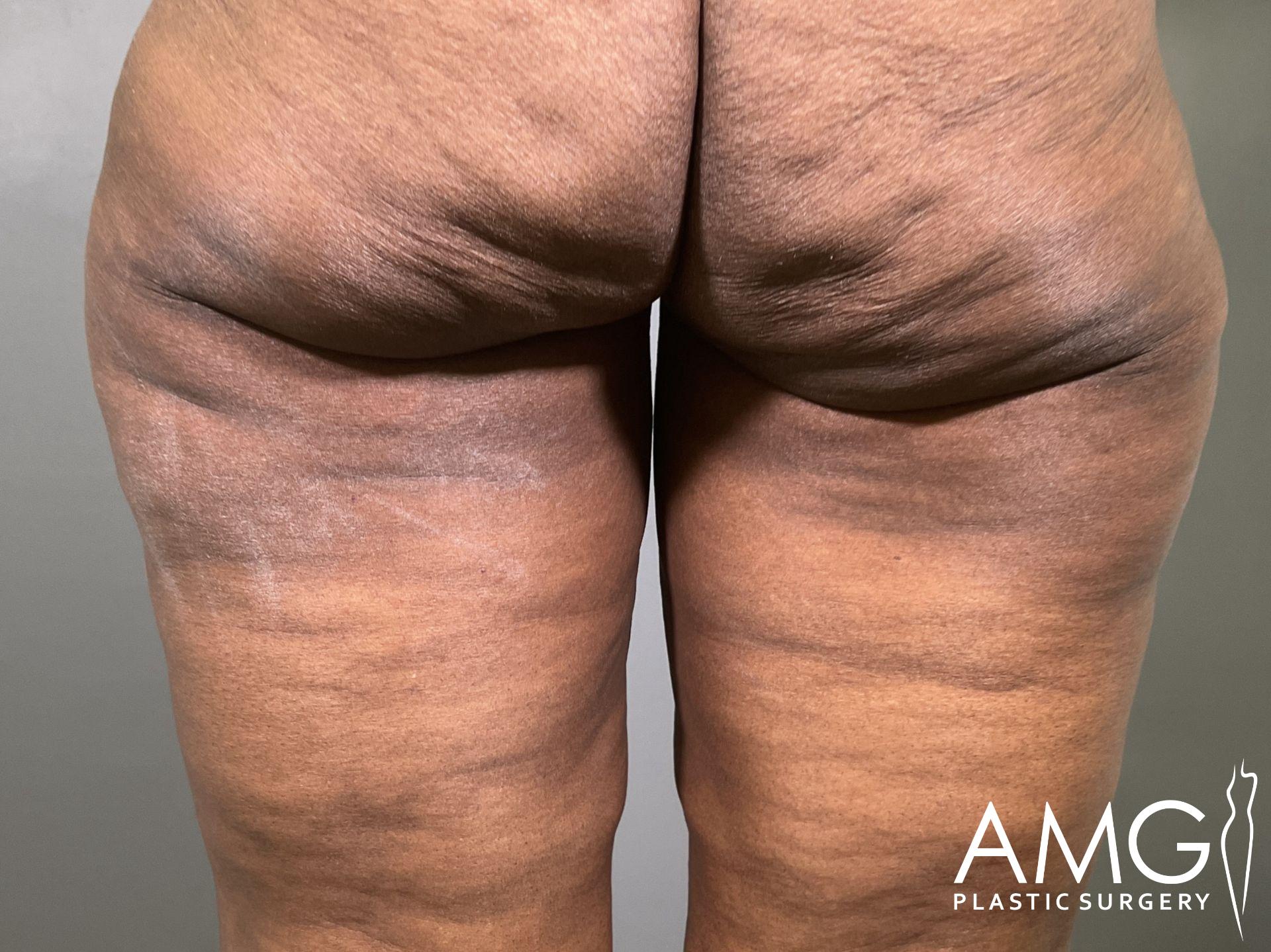 Close-up of the back of a person's thighs and buttocks showing skin texture and mild dimpling. AMG Plastic Surgery logo is visible in the bottom right corner.