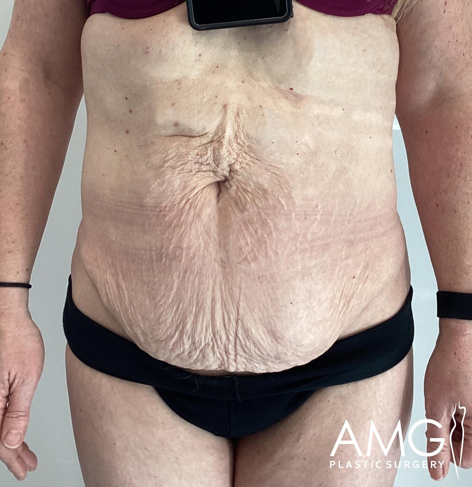 Close-up of a person’s abdomen with visible skin folds and surgical markings. They wear black shorts, and a device hangs around the neck. The logo "AMG Plastic Surgery" is visible.