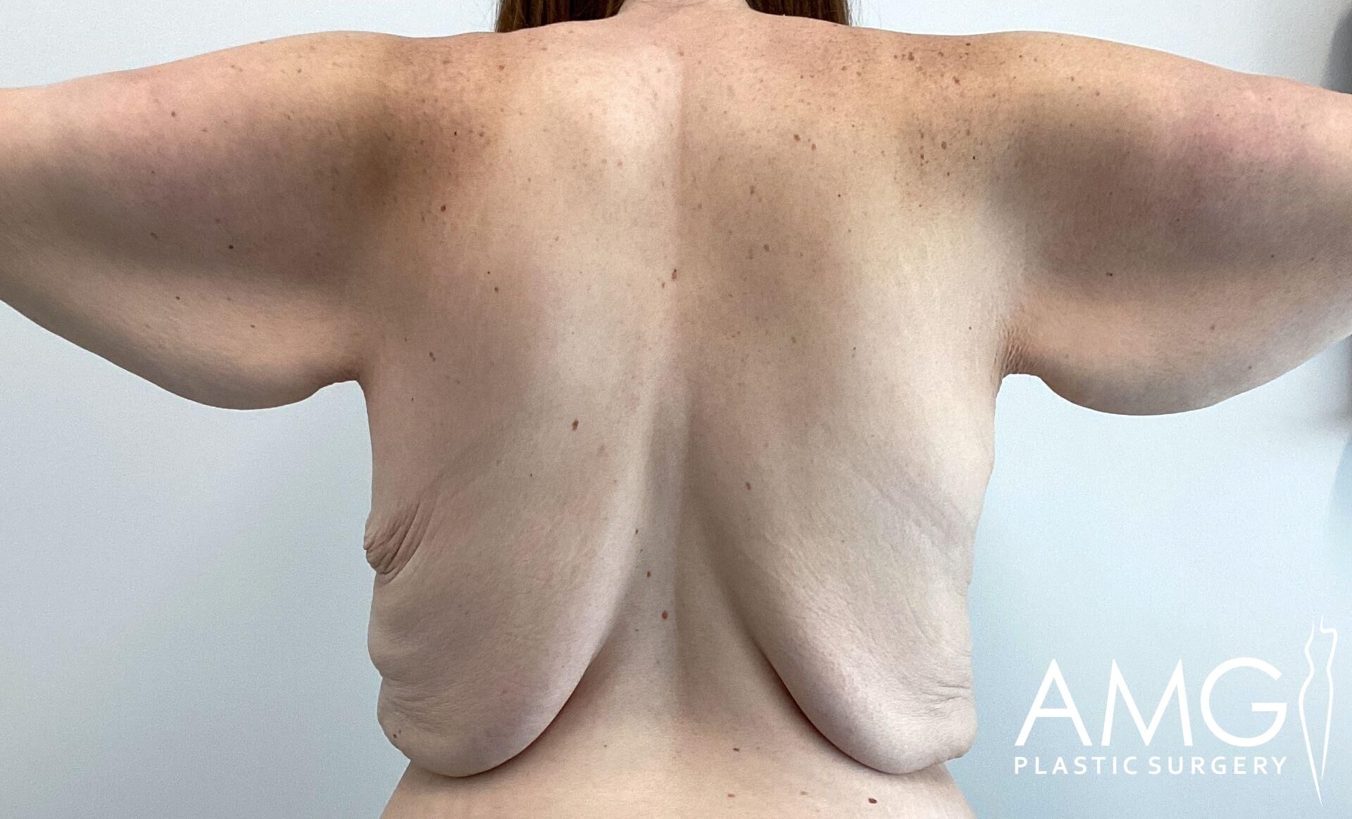 A person with outstretched arms showing excess skin and fatty tissue under the arms and back.