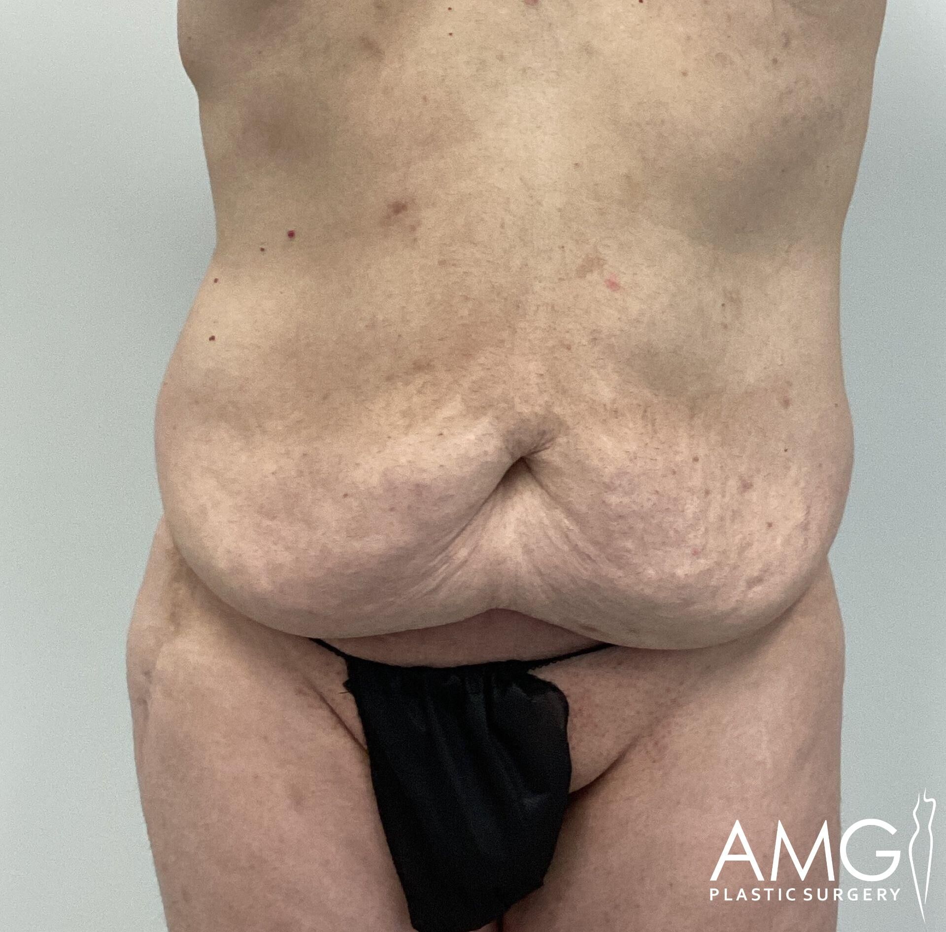 A person's abdomen before body contouring surgery, showing excess skin and tissue.