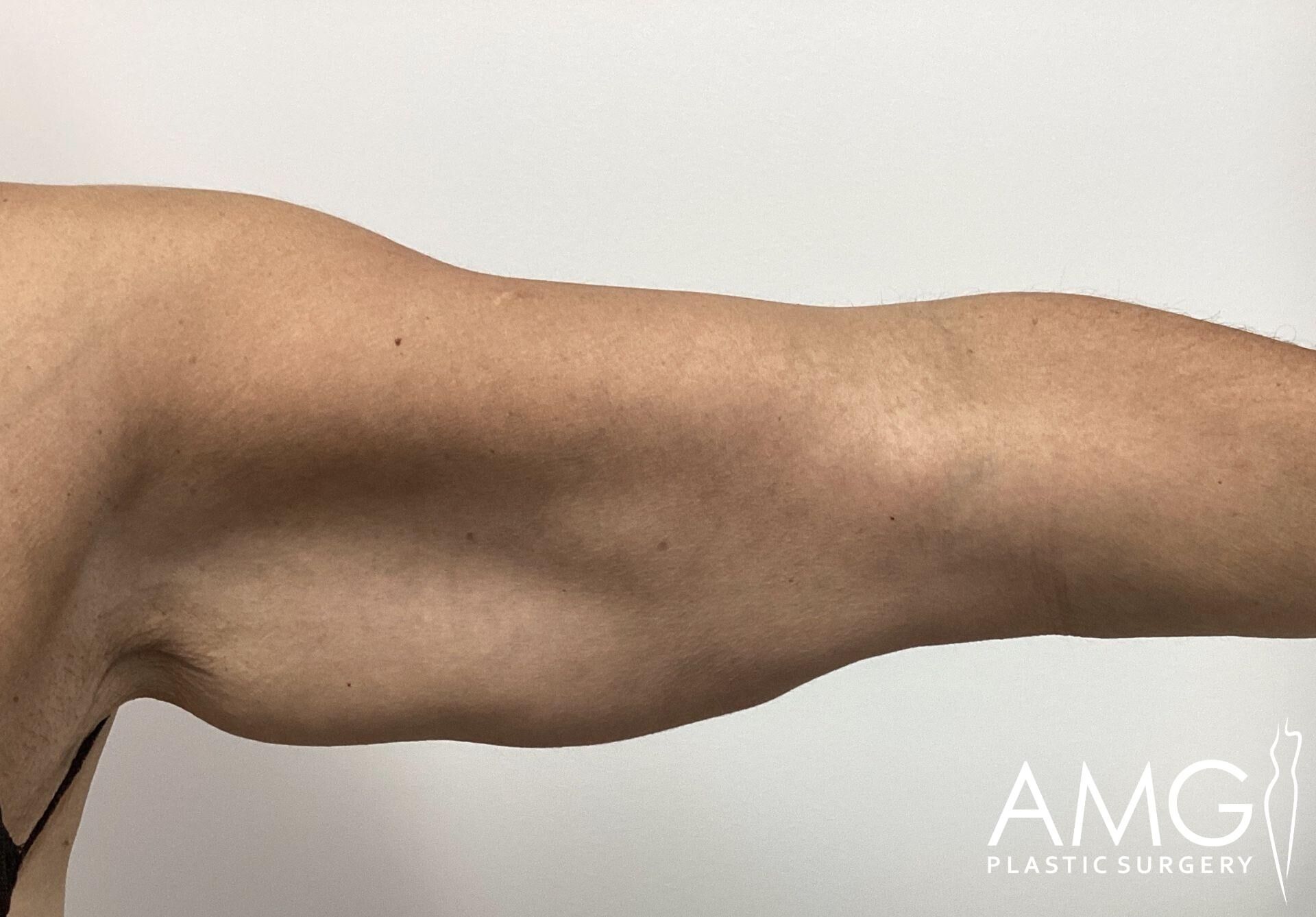 Close-up of an outstretched human arm showing muscle definition against a plain background.
