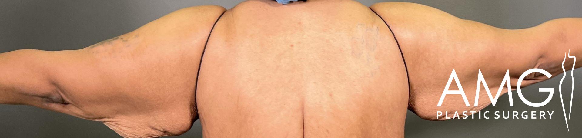 Person's back with arms extended, showing excess skin. AMG Plastic Surgery logo in the corner.