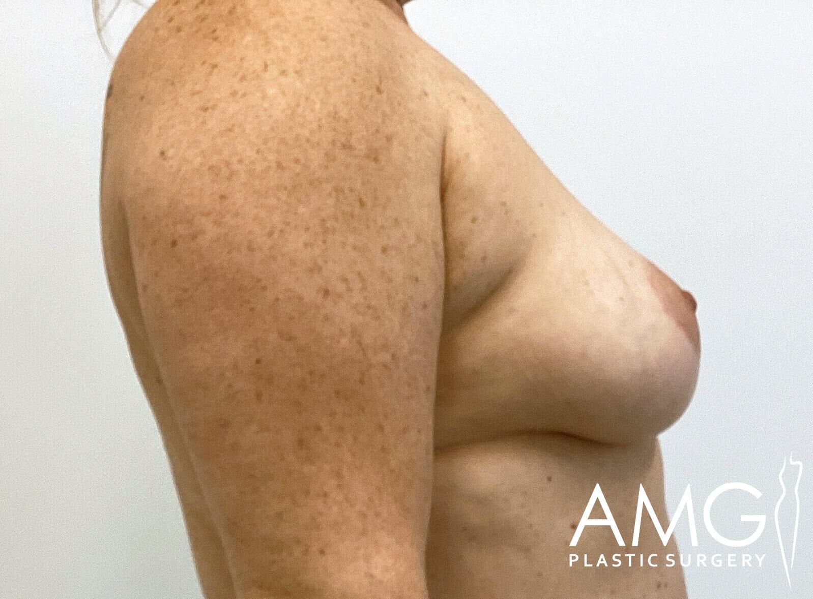 Side profile of an unclothed upper torso displaying a woman's chest and arm against a plain background. AMG Plastic Surgery logo is visible in the corner.