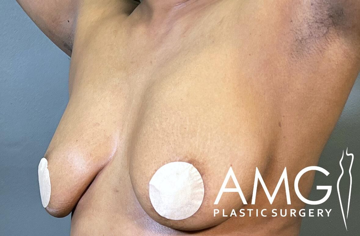 A person's torso with adhesive covers on the nipples, displaying results of breast surgery. AMG Plastic Surgery logo is visible.
