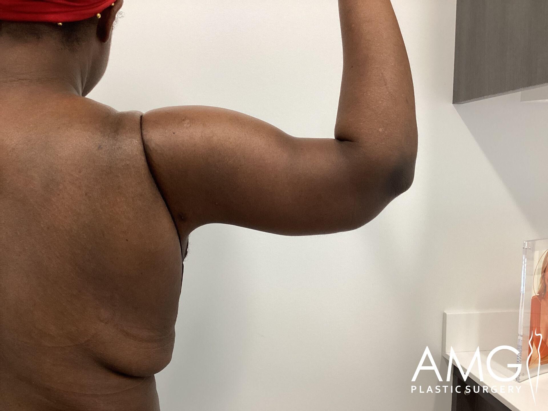 A person with a bare back and flexed arm stands in a clinical setting, displaying muscle definition. A logo reading 