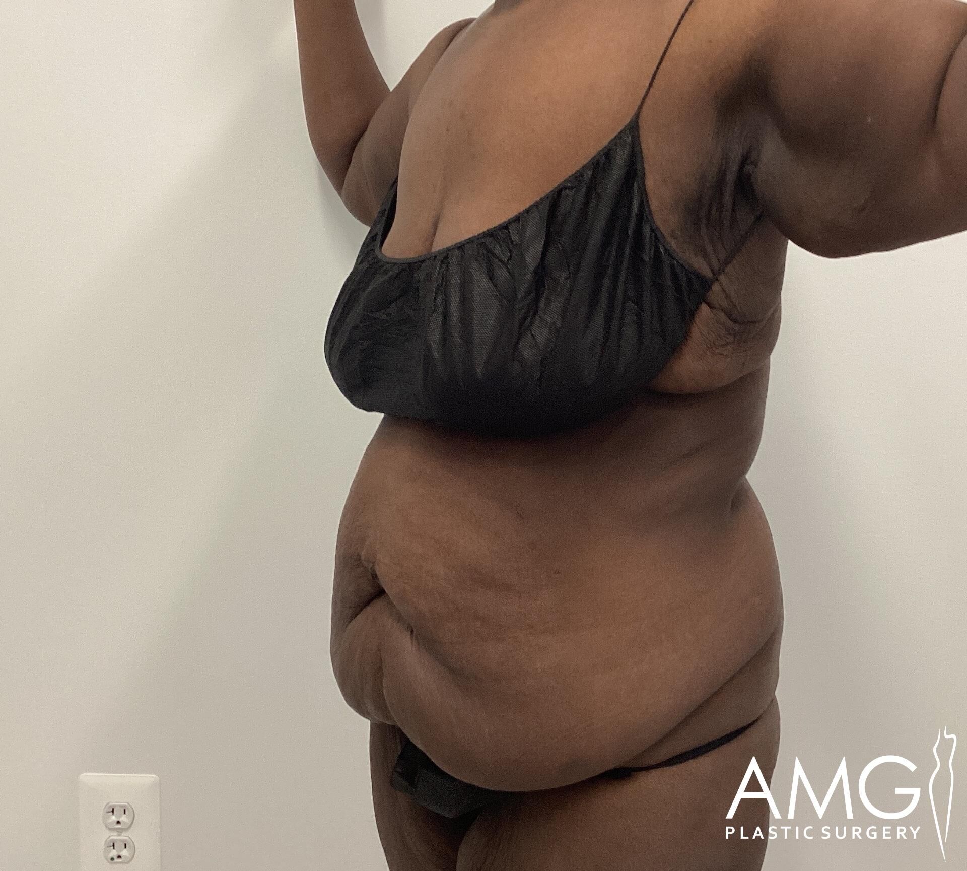 Side view of a person wearing a black bra and underwear, showing skin folds and contours. The logo "AMG Plastic Surgery" is in the bottom right corner.