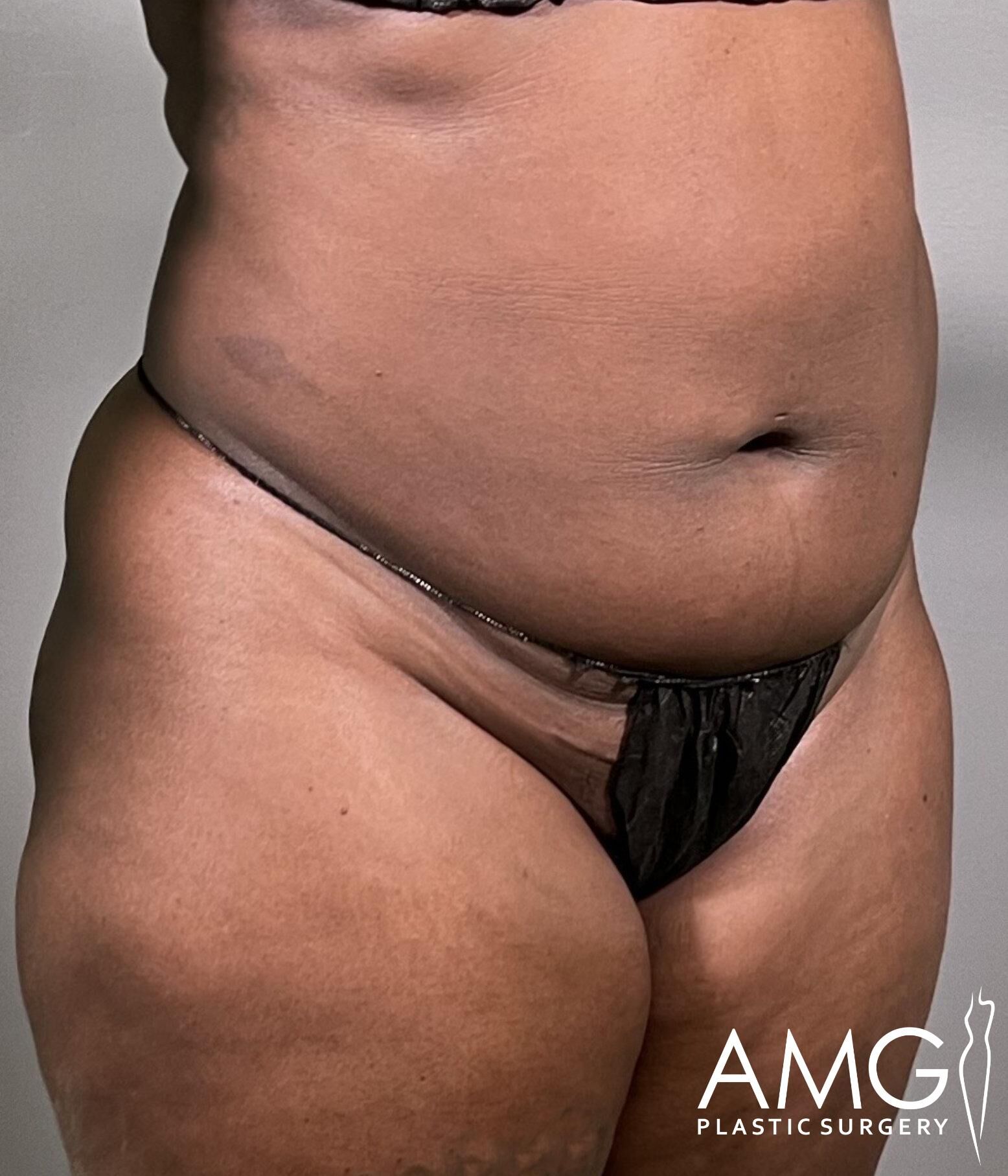 Close-up of a person's midsection, showing their stomach and hips. They are wearing black undergarments. A logo reading "AMG Plastic Surgery" is in the bottom right corner.