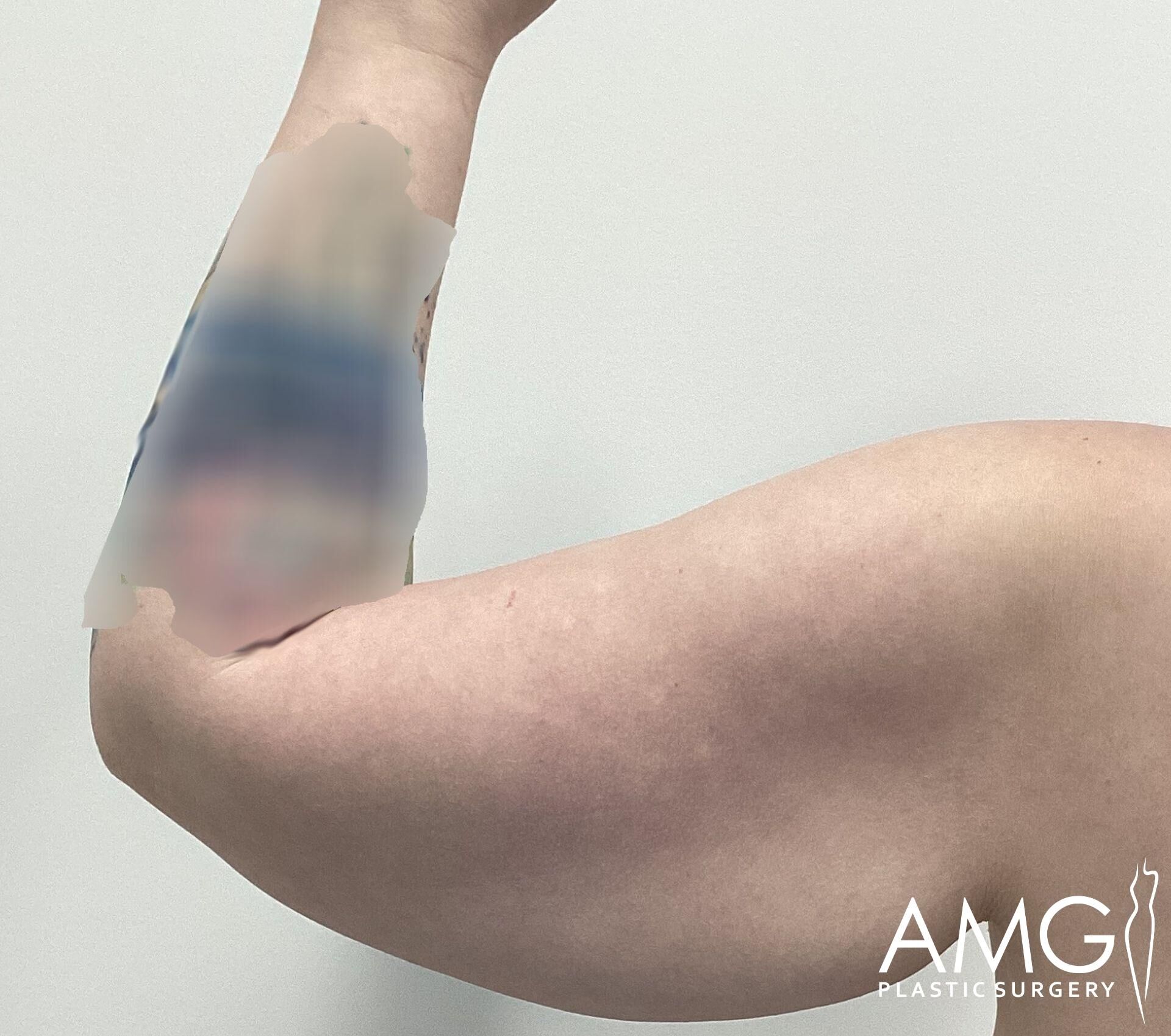 A close-up of a person's raised arm, showing loose skin and muscle definition. The image is marked with "AMG Plastic Surgery" in the bottom right corner.