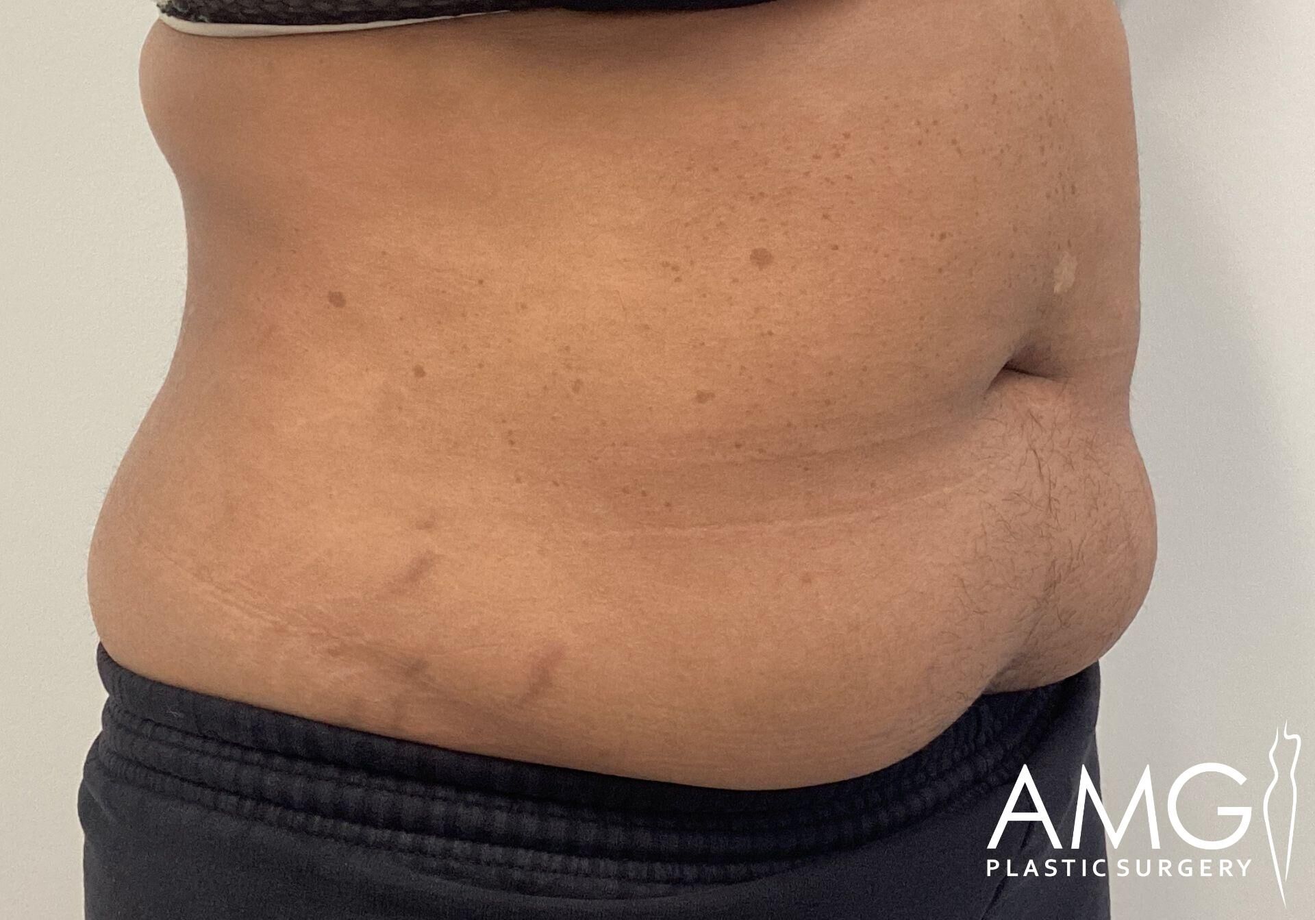 Side view of a person’s midsection showing excess abdominal skin with the text "AMG Plastic Surgery" in the corner.