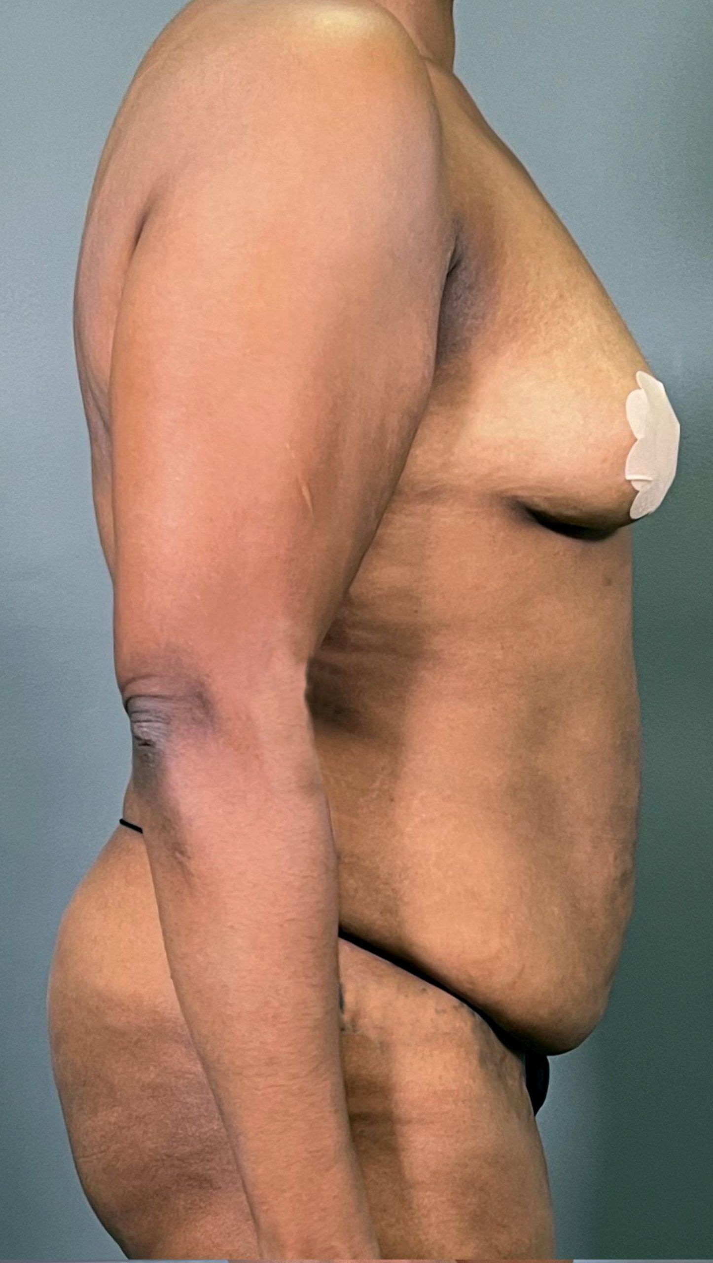 Side profile of a person standing against a grey background, with a surgical tape on the chest and "AMG Plastic Surgery" logo at the bottom.