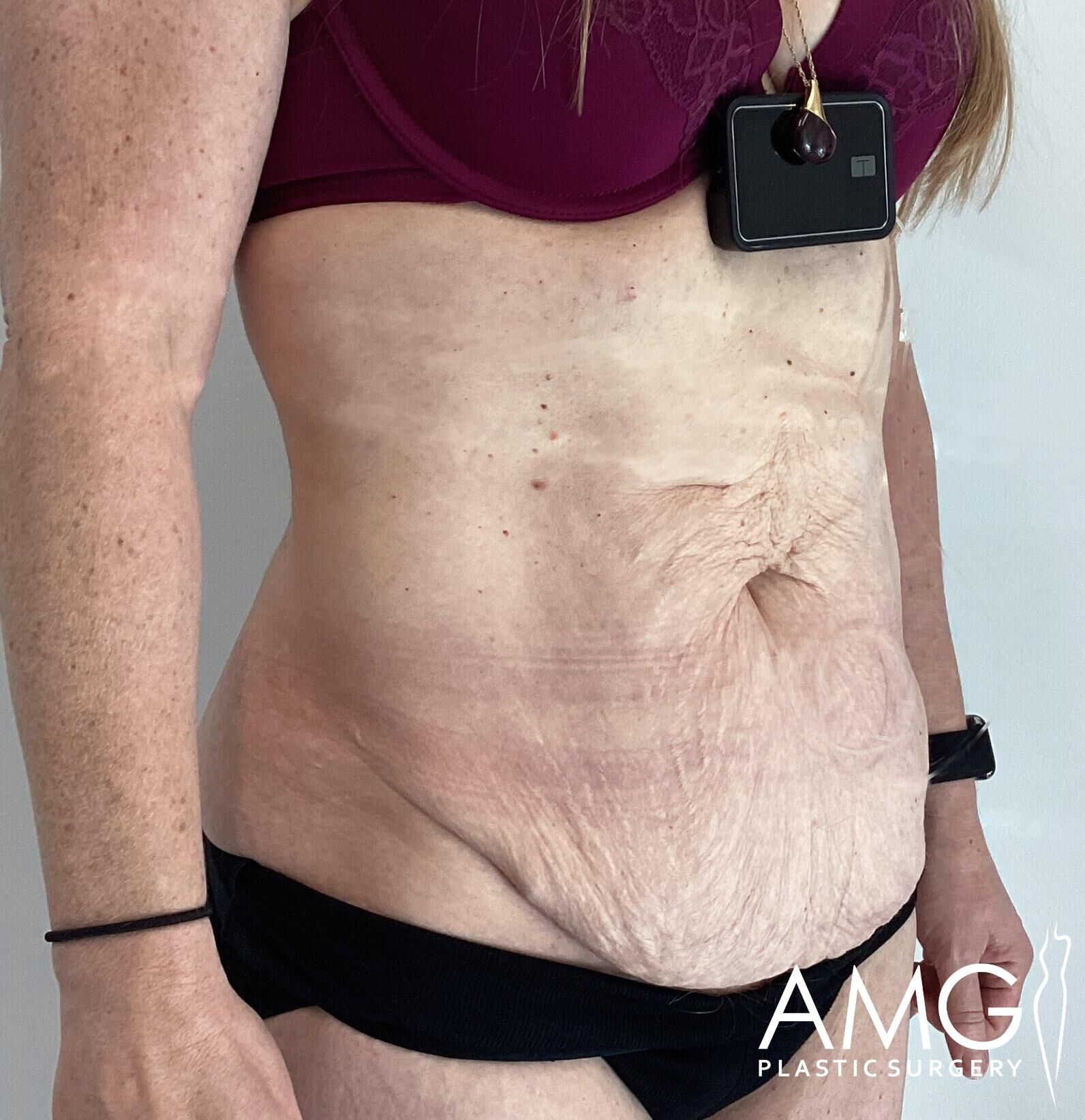 Side view of a woman with loose abdominal skin wearing a maroon bra and black underwear. A small device is attached to her chest. The image has a logo for AMG Plastic Surgery.