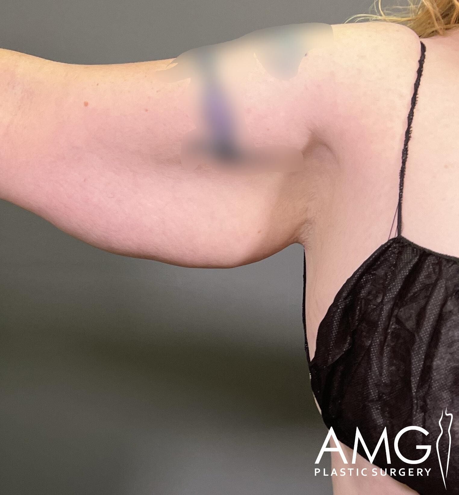 A person wearing a black spaghetti strap top shows an upper arm with a blurred tattoo, with AMG Plastic Surgery logo in the corner.