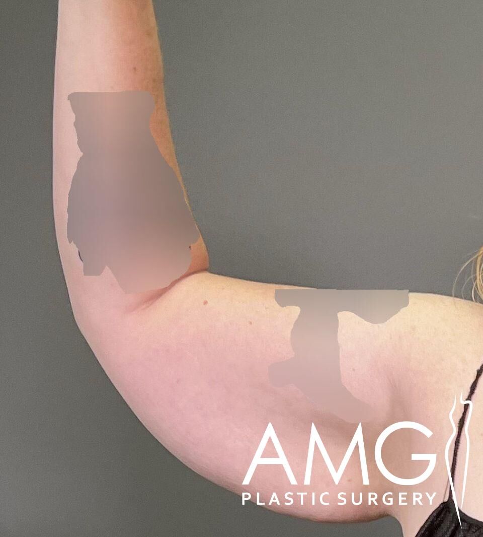A person's arm is shown, flexed, with visible markings or edits over certain areas. "AMG Plastic Surgery" is written on the image.