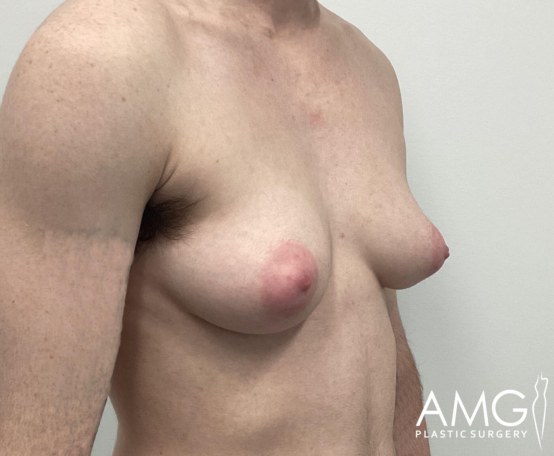 A person's chest with gynecomastia condition, displayed side-on.