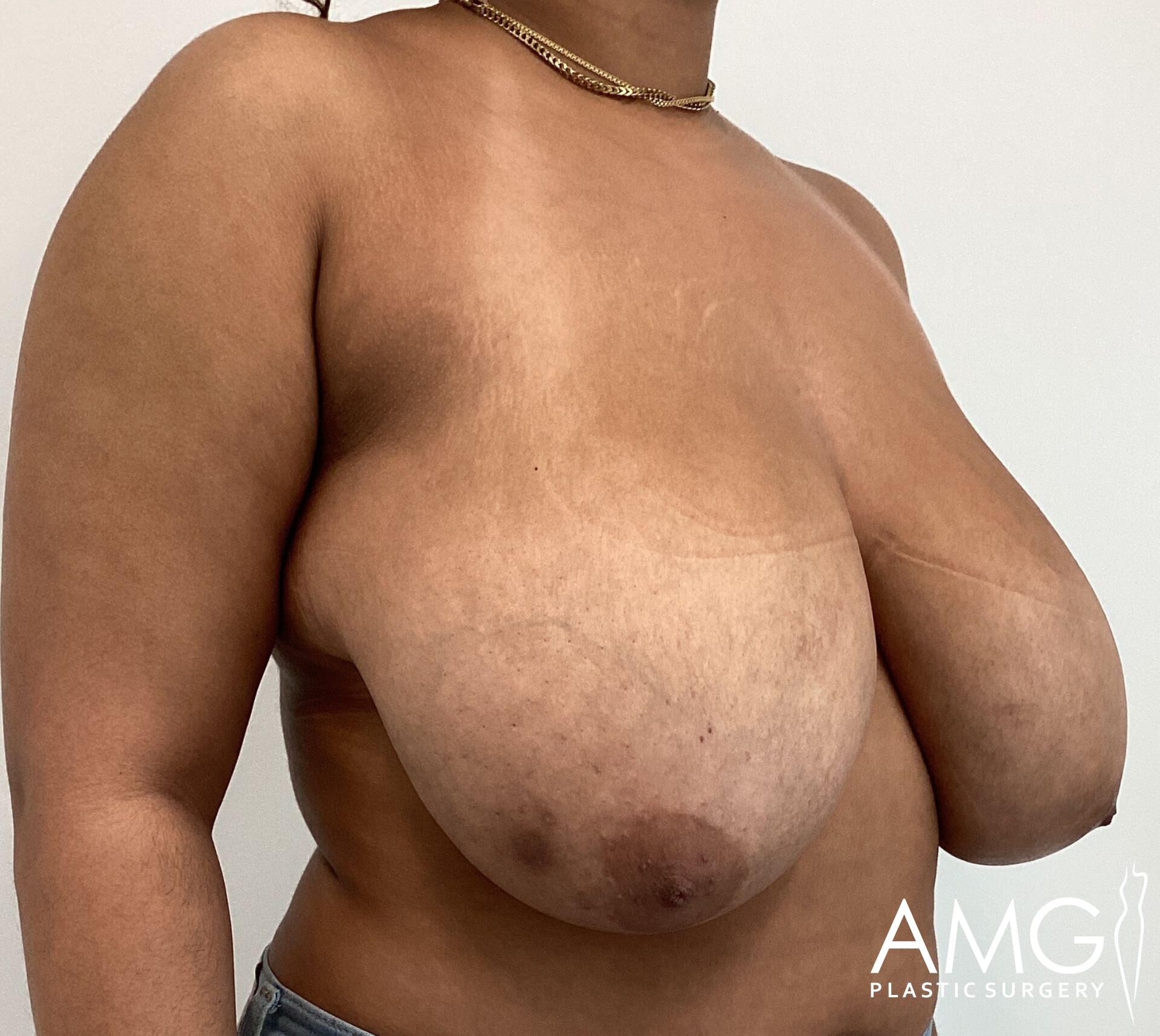 Person with a large breast before surgery, shown from the side. A necklace and denim pants are partially visible. Logo reads "AMG Plastic Surgery.